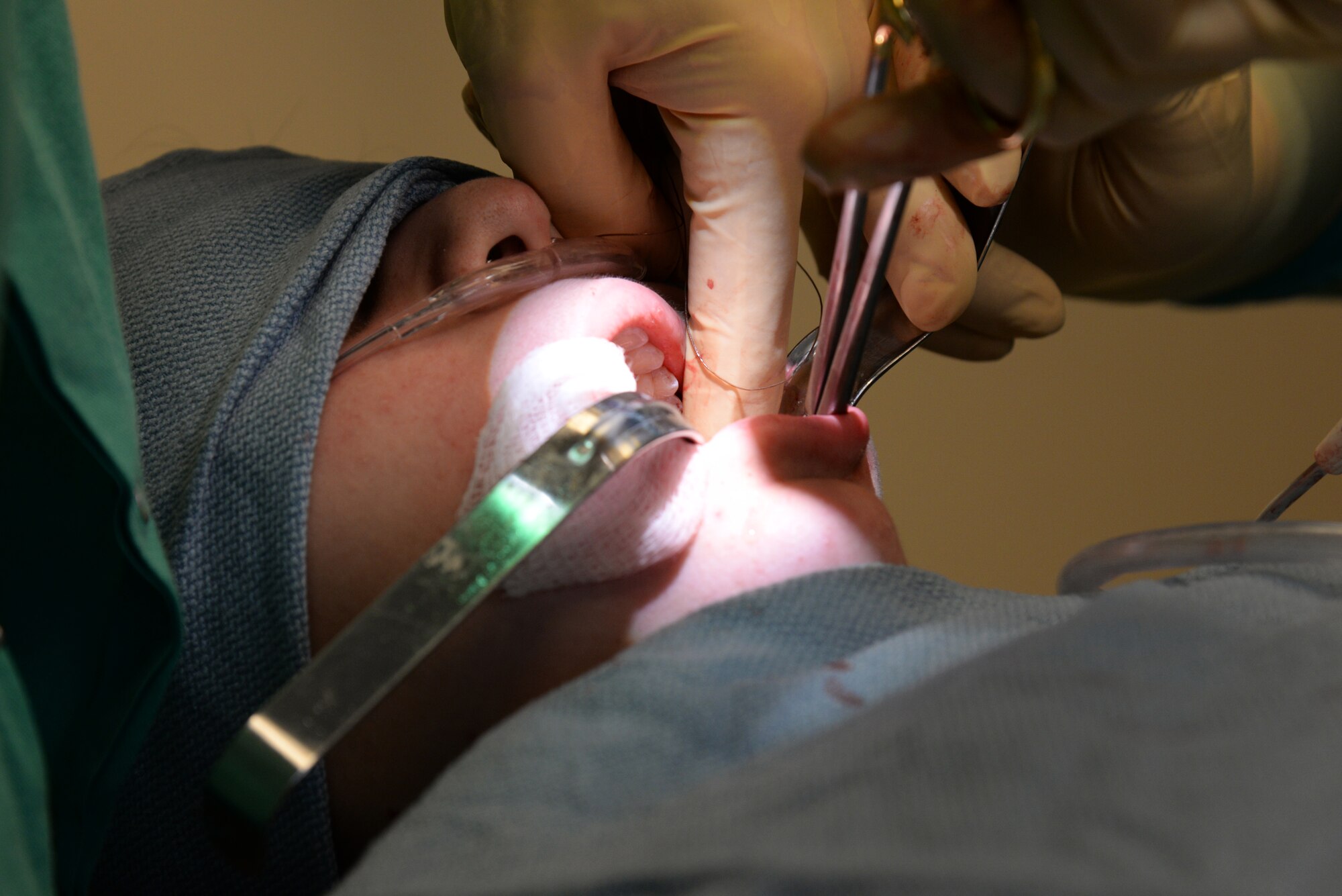 Capt. Kyle Christensen and Lisa Whisenhunt perform a wisdom teeth extraction April 8, 2015, at the Scott Clinic, Scott Air Force Base, Illinois. Wisdom teeth are extracted to correct or prevent future problems that may occur. Christensen is a General Dentist and Whisenhunt is a Dental Technician from the 375th Dental Squadron. (U.S. Air Force Photo by Airman 1st Class Megan Friedl)