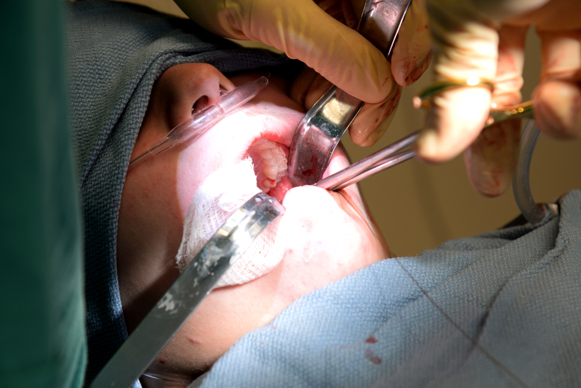 Capt. Kyle Christensen and Lisa Whisenhunt perform a wisdom teeth extraction April 8, 2015, at the Scott Clinic, Scott Air Force Base, Illinois. Wisdom teeth are extracted to correct or prevent future problems that may occur. Christensen is a General Dentist and Whisenhunt is a Dental Technician from the 375th Dental Squadron. (U.S. Air Force Photo by Airman 1st Class Megan Friedl)