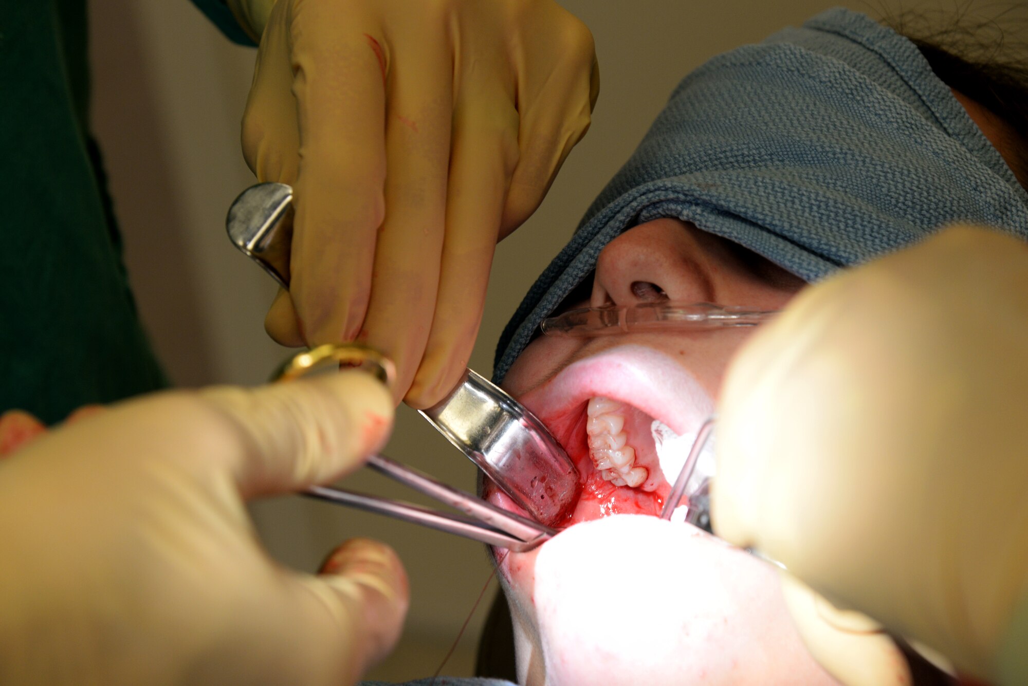 Capt. Kyle Christensen and Lisa Whisenhunt perform a wisdom teeth extraction April 8, 2015, at the Scott Clinic, Scott Air Force Base, Illinois. Wisdom teeth are extracted to correct or prevent future problems that may occur. Christensen is a General Dentist and Whisenhunt is a Dental Technician from the 375th Dental Squadron. (U.S. Air Force Photo by Airman 1st Class Megan Friedl)
