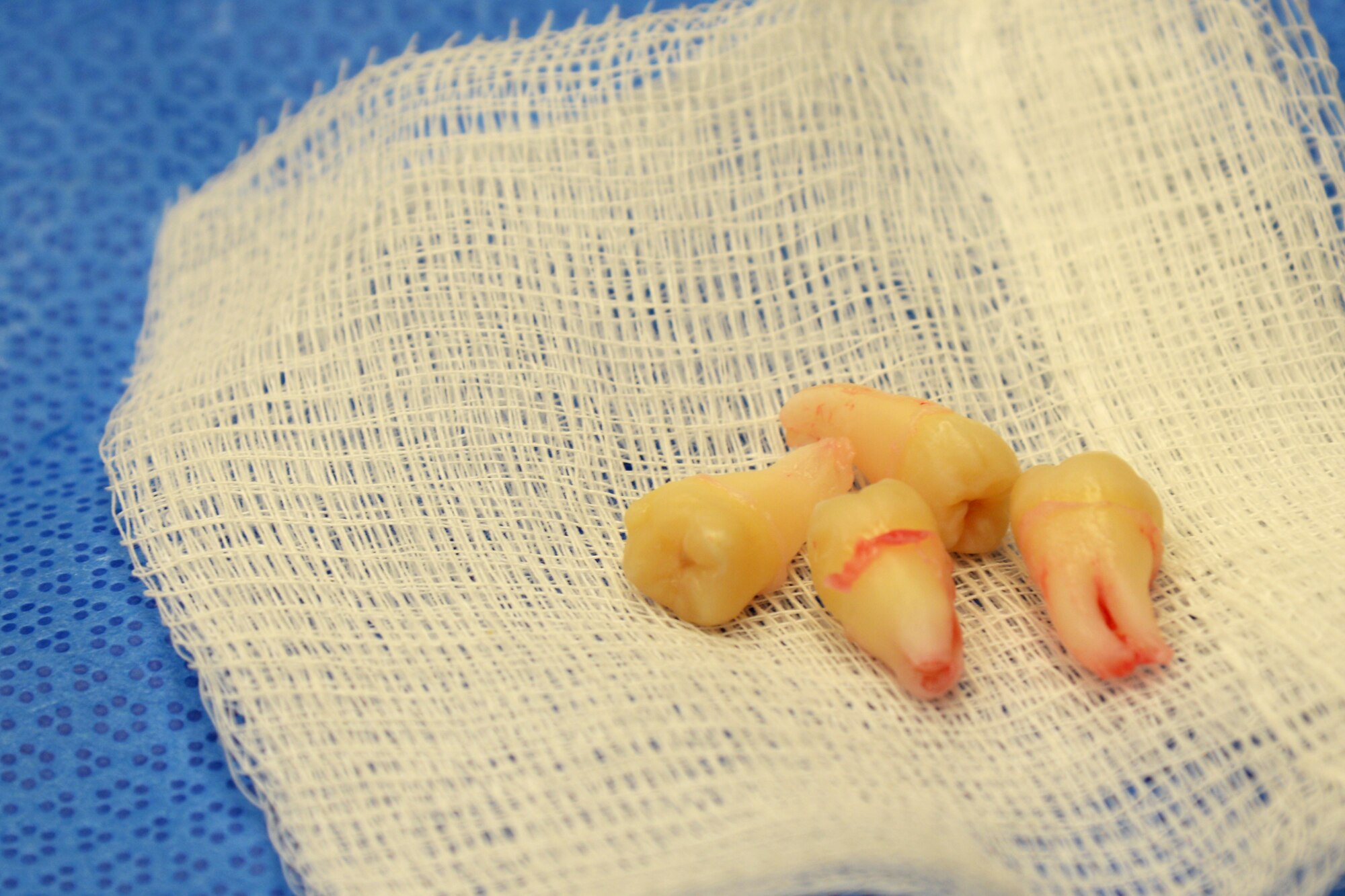 The 375th Dental Squadron Oral Surgery Clinic operates on thousands of patients to remove wisdom teeth, provide care for biopsies, trauma, implants, care for facial infections and other jaw related problems. Wisdom teeth are removied to correct or prevent future problems that may occur. (U.S. Air Force Photo by Airman 1st Class Megan Friedl)