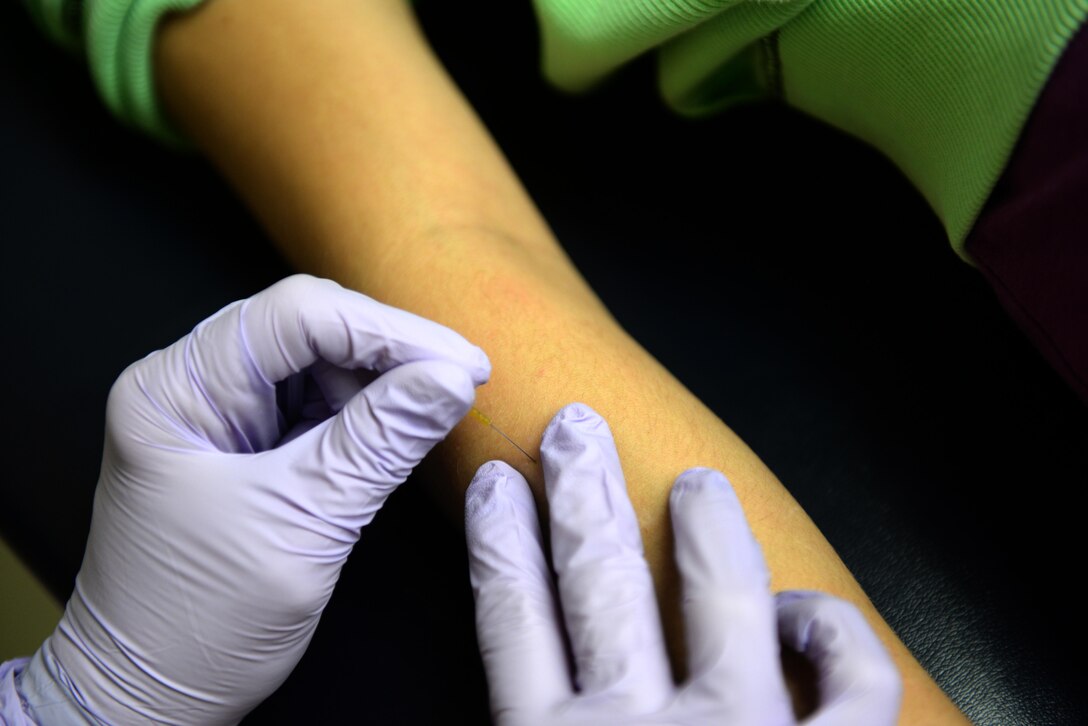 A patient receives dry needling to help with wrist pain, Nov. 18, 2015, at Seymour Johnson Air Force Base, North Carolina. Dry needling is a form of acupuncture in which the needle is placed directly into a muscle knot triggering release of tension and easing pain. (U.S. Air Force photo/Airman 1st Class Ashley Williamson)