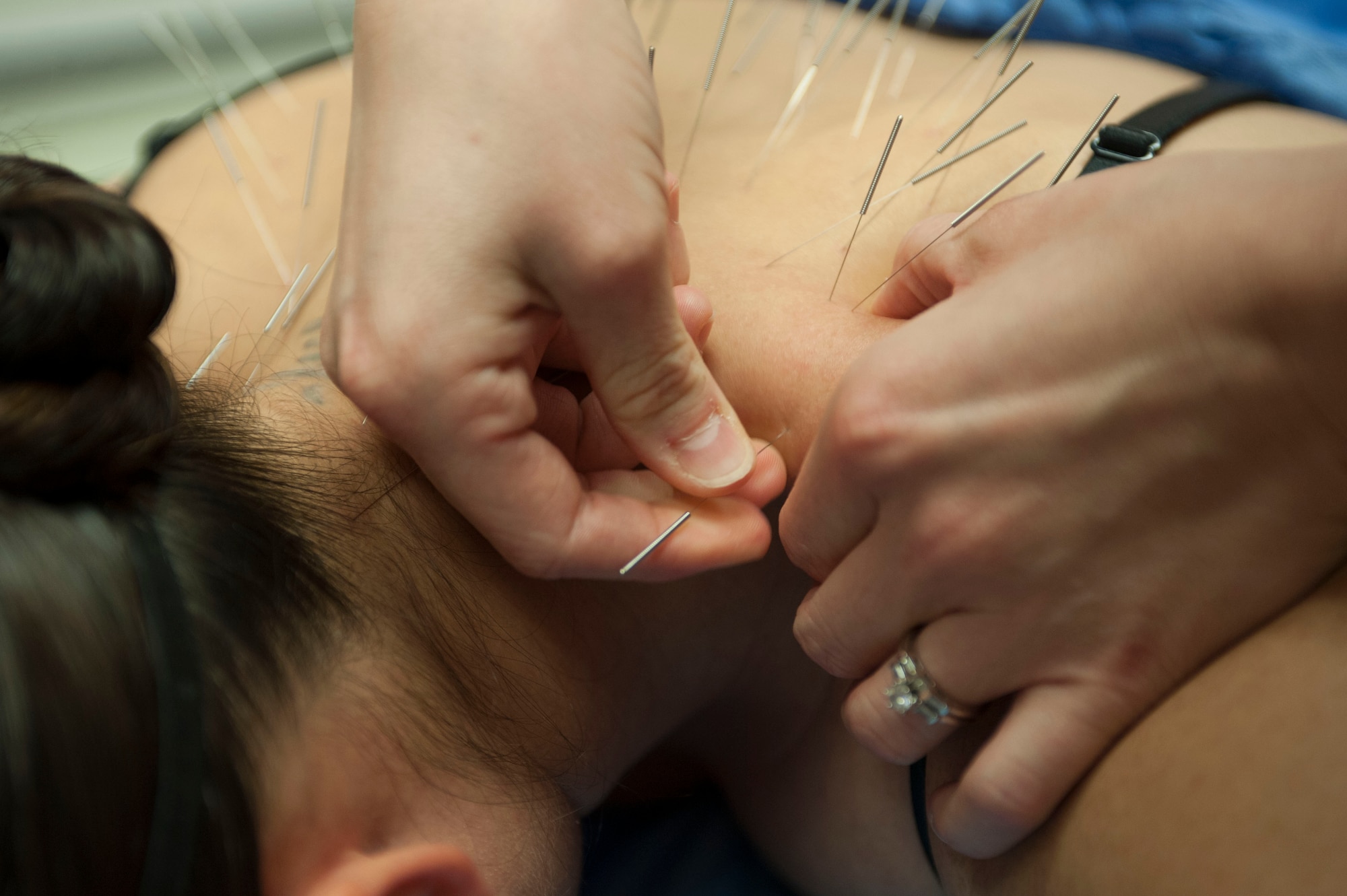 Airman 1st Class Tawni Deboma, 99th MDOS medical technician, has acupuncture needles inserted into her back at the Mike O’ Callaghan Federal Medical Center on Nellis Air Force Base, Nev., Oct. 26, 2015. Most acupuncture needles are transient, meaning they are left in for about 20 to 30 minutes and then removed. Needles inserted into the ear can stay in for up to a week. (U.S. Air Force photo by Senior Airman Mikaley Kline)
