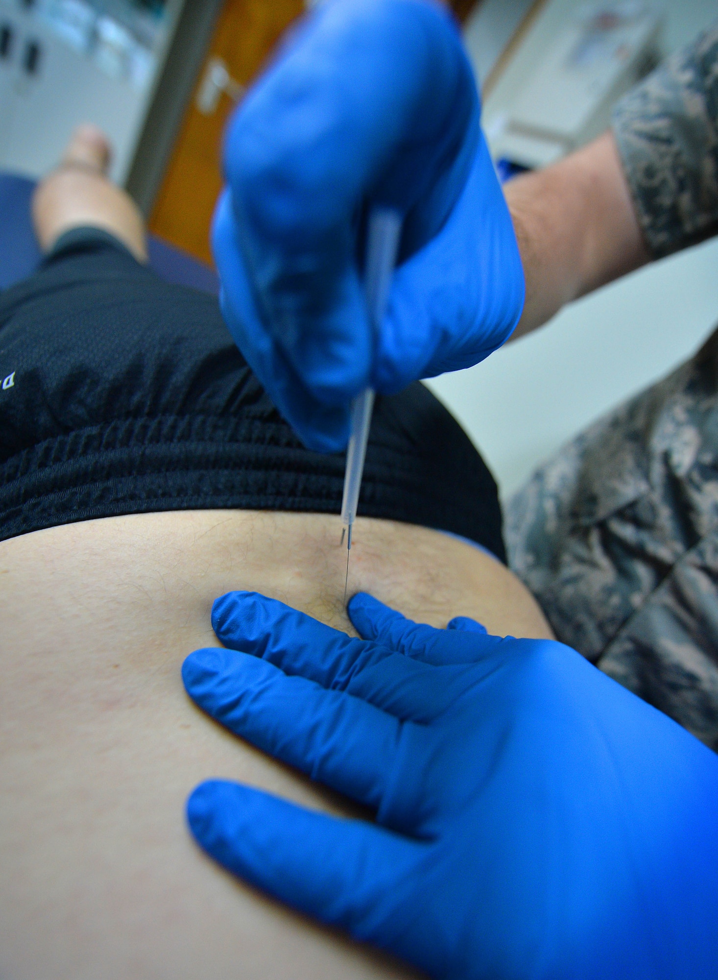 Capt. Joshua, 380th Expeditionary Medical Squadron physical therapist, uses trigger-point dry needling to help relieve a patient’s back injury at an undisclosed location in Southwest Asia Sept. 1, 2015. The physical therapy team is responsible for evaluating patients and utilizing different therapeutic procedures to help restore patient functions. (U.S. Air Force photo/Tech. Sgt. Jeff Andrejcik)  
