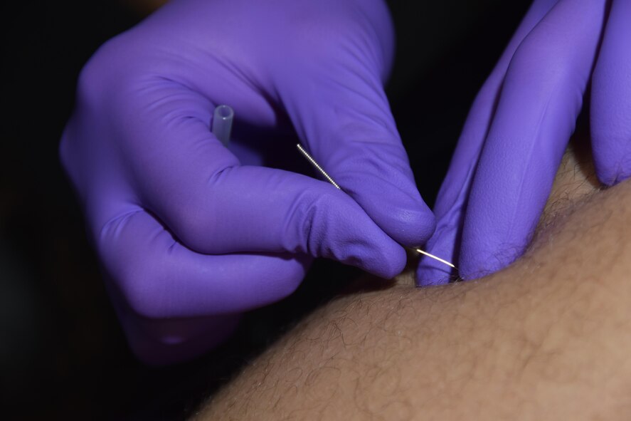 Maj. Erin R. Sturgell, 379th Expeditionary Medical Operations Squadron physical therapist, inserts a dry needle into the quadriceps of U.S. Army Sgt. Karl Hawthorne, Combined Air Operations Center air defense communications and tactics specialist, July 28, 2016, at Al Udeid Air Base, Qatar. Dry needling treats muscular dysfunction and is a healing technique used to relieve pain and helps muscle fibers to reset and restore their function. (U.S. Air Force photo/Technical Sgt. Carlos J. Treviño/Released)  