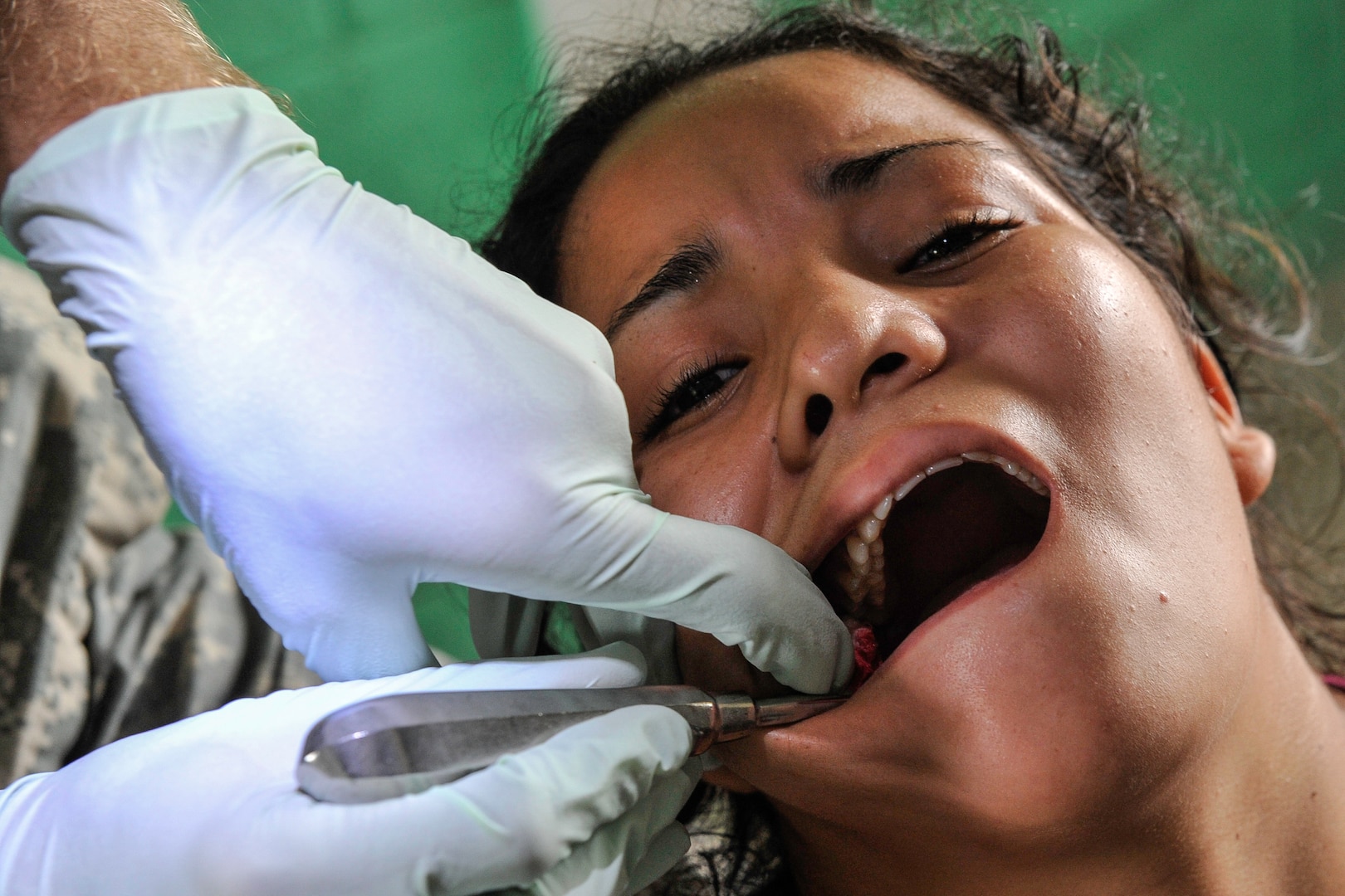 An adolescent girl has a wisdom tooth pulled by U.S. Army Maj. (Dr.) David Bennett, Joint Task Force-Bravo Medical Element dentist, during a Medical Readiness Training Exercise operation in Trujillo, Honduras, July 29, 2016. During this two-day MEDRETE, the dental section treated more than 200 patients. (U.S. Air Force photo by Staff Sgt. Siuta B. Ika)