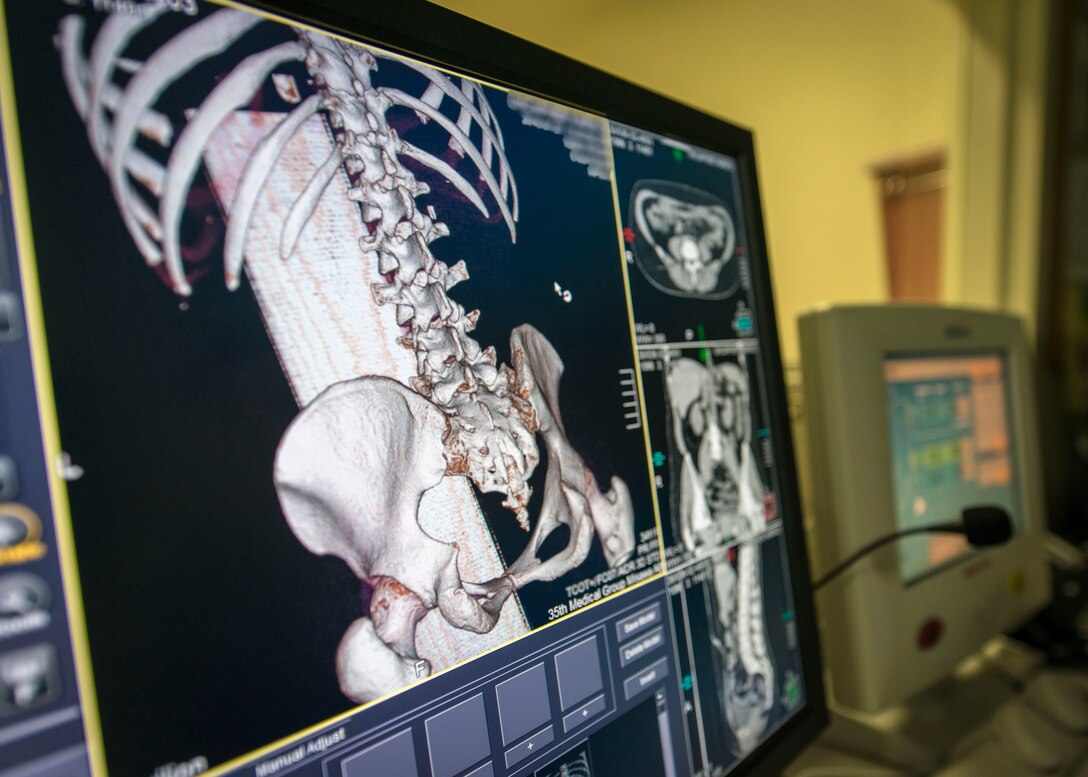 U.S. Air Force Airman 1st Class Samantha Bradford, a diagnostic imaging technologist with the 35th Surgical Operations Squadron, analyzes a patient’s bone structure after conducting a computerized tomography scan at Misawa Air Base, Japan, Jan. 27, 2016. With these machines, Bradford said they can see 3-D reconstructions, or digital slices of the body, from a patient’s bones to elements as small as blood vessels. When a few seconds could mean the difference between life and death, these scans make it easier to see nearly everything there is to know about the patient. Bradford is a Corinth, Maine, native. (U.S. Air Force photo by Staff Sgt. Benjamin W. Stratton)