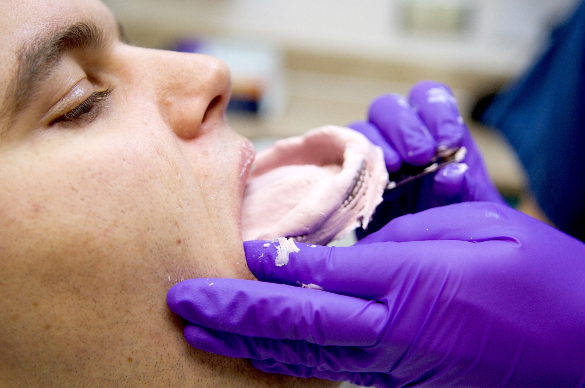 U.S. Air Force Airman 1st Class Savannah Ziegler, 39th Medical Operations Squadron dental technician, removes an impression of Senior Airman Charles Poston, 39th Logistics Readiness Squadron fuels fixed facilities technician, teeth Jan. 28, 2016, at Incirlik Air Base, Turkey.  Poston’s impressions will be used to create a mold, which will be used to create a sports mouthpiece. (U.S. Air Force photo by Staff Sgt. Jack Sanders/Released)