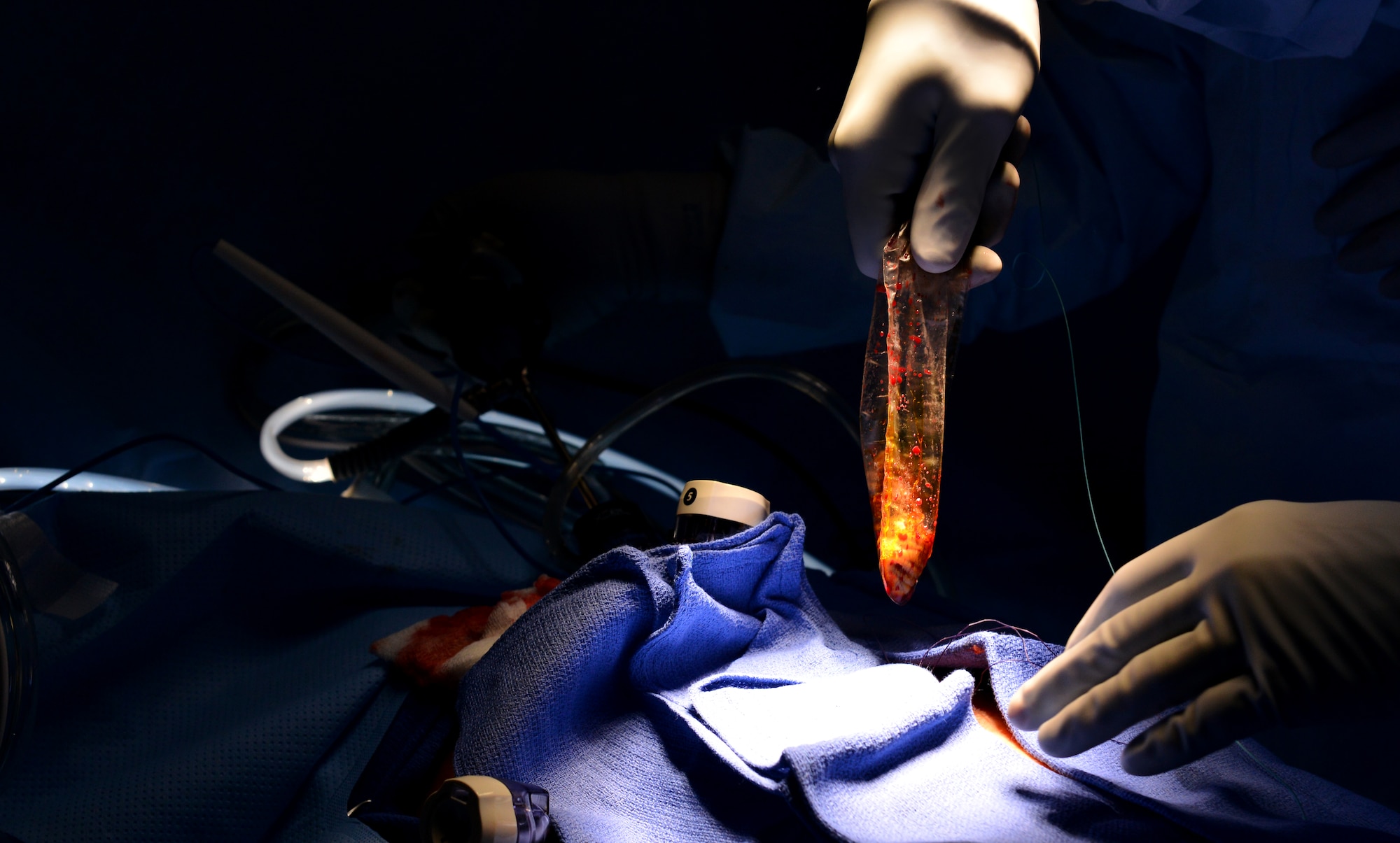 Surgeries like the gall bladder removal taking place here are one of many different procedures the highly-trained personnel of the 673d MDG on Joint Base Elmendorf-Richardson perform every day. As of February 2016, 75 percent of the 673d Medical Group's operating room nurses have their Certified Nurse Operating Room certification, making 673d MDG the only CNOR Strong designated facility in Alaska. (U.S. Air Force photo by Airman 1st Class Kyle Johnson)