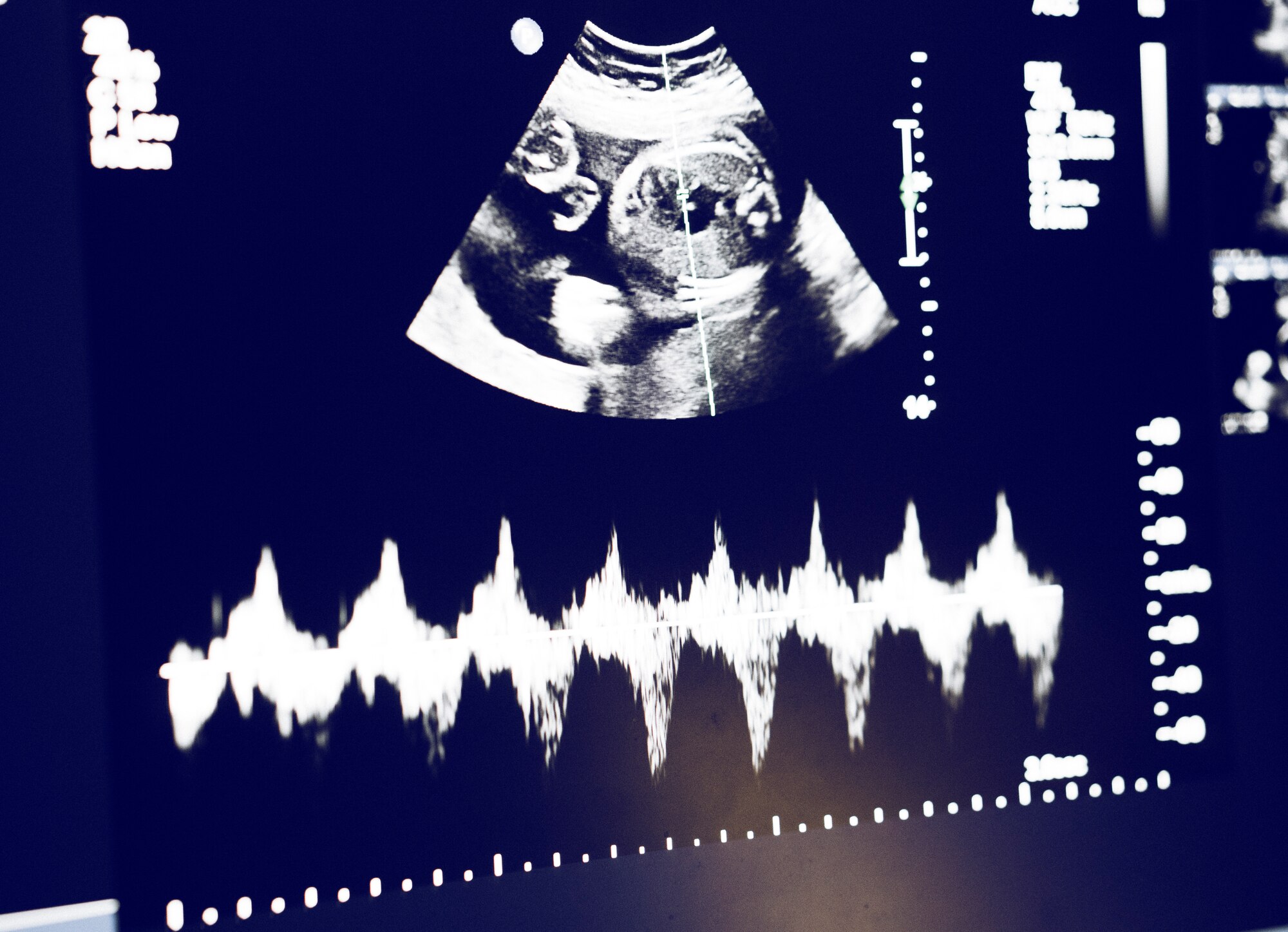 Staff Sgt. Brandon Joyce, 374th Surgical Operations Squadron surgical services NCO in charge of sonography, produces an ultrasound, Feb. 11, 2016, at Yokota Air Base, Japan. Diagnostic imaging services like ultrasound create visual representations of the interior of a body for clinical analysis and medical intervention. (U.S. Air Force photo by Airman 1st Class Delano Scott/Released) 
