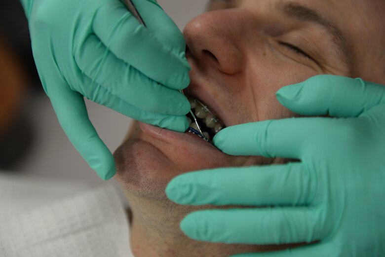 Senior Airman Alicia Rosdahl, a dental technician with the 423rd Medical Squadron, removes an elastic chain from a patient’s braces, during a checkup at the RAF Alconbury, United Kingdom, Dental Clinic, Jan.6, 2015. Rosdahl, who is still relatively new to RAF Alconbury, said she enjoys the chance this assignment has given her to learn more about orthodontia. (U.S. Air Force photo by Airman 1st Class Zachary Bumpus/Released)