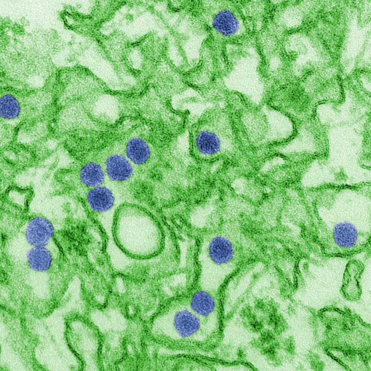 This is a digitally-colorized transmission electron micrograph of Zika virus, which is a member of the family Flaviviridae. Virus particles, here colored red, are 40 nanometers in diameter with an outer envelope and an inner dense core. Zika virus is spread to people through mosquito bites. The most common symptoms of Zika virus disease are fever, rash, joint pain and conjunctivitis, or red eyes. The illness is usually mild with symptoms lasting from several days to a week. Severe disease requiring hospitalization is uncommon. Centers for Disease Control and Prevention photo by Cynthia Goldsmith