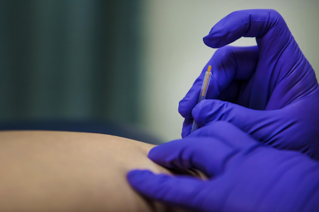 Air Force Maj. Brandon Morgan, not shown, conducts a dry needling procedure while treating a patient at Bagram Airfield, Afghanistan, July 19, 2016. Dry needling stimulates the muscle, heloing it to relax and ease strain. Air Force photo by Senior Airman Justyn M. Freeman