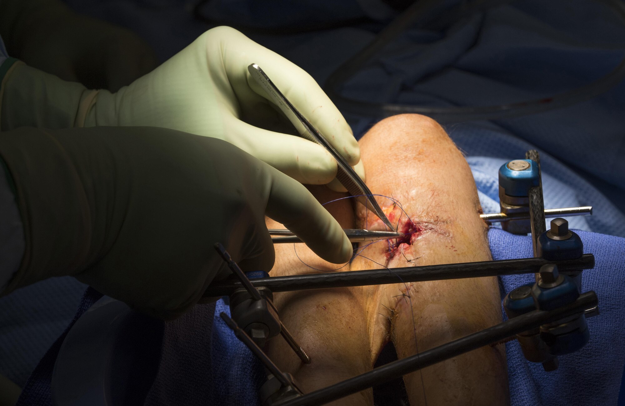A doctor sews up an open wound on a patient during a surgery at Craig-Joint Theater Hospital, June 10, 2016, Bagram Airfield, Afghanistan. In an effort to save the patients leg, suffering from a bullet wound, surgeons have placed a flap of skin procured from the backside of her legs over the wound to prevent infection and promote healing. (U.S. Air Force photo by Tech. Sgt. Tyrona Lawson)