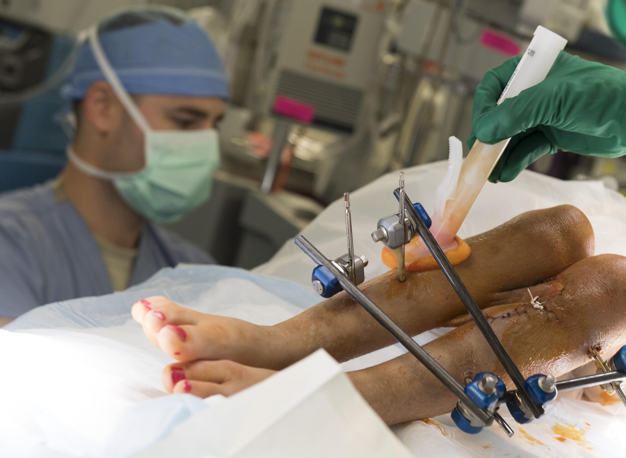 Maj. David Vizurraga, 455th Expeditionary Medical Group orthopedic surgeon, sterilizes the legs of an Afghan patient as Lt. Col. Edward Lopez, 455th EMDG anesthesiologist, monitors her vitals during surgery, June 10, 2016 at Craig-Joint Theater Hospital, Bagram Airfield, Afghanistan. The patient has undergone multiple surgeries to help repair her leg after being shot. (U.S. Air Force photo by Tech. Sgt. Tyrona Lawson)