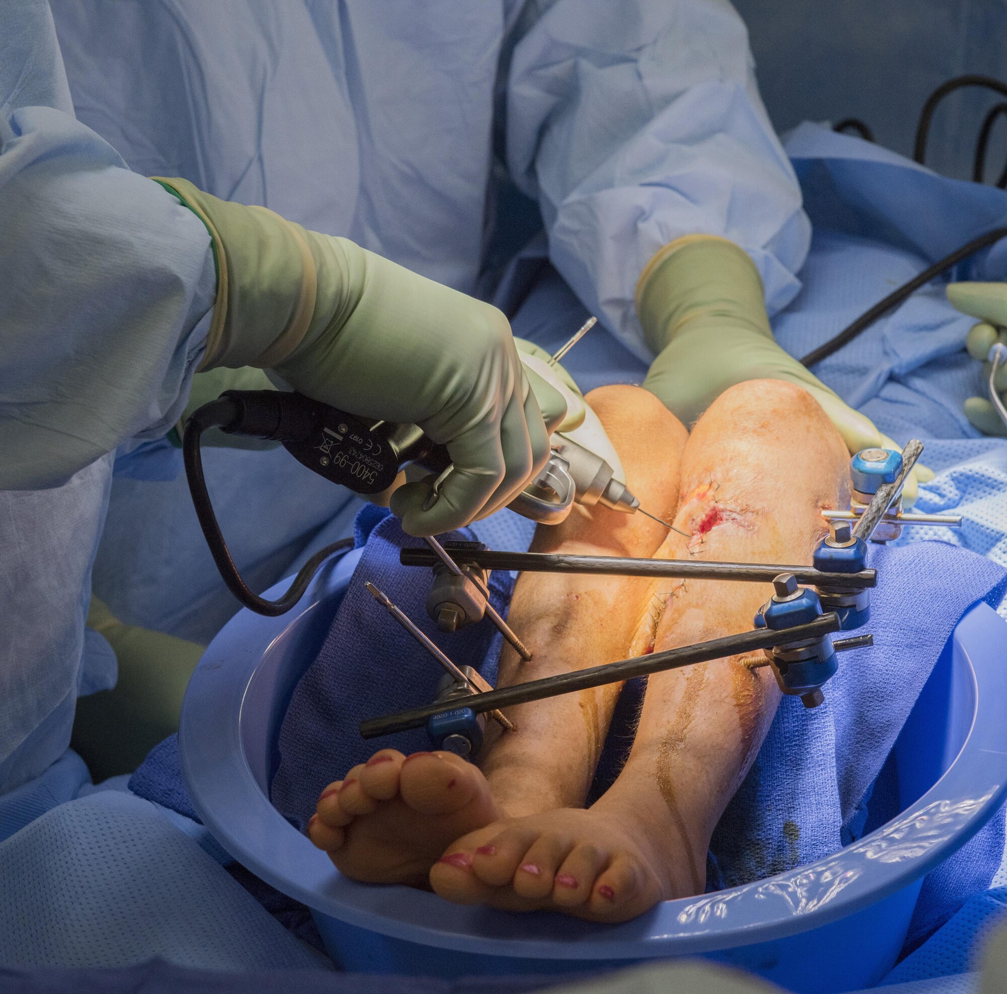 Doctors drill into the legs of an Afghan patient during a surgery at the Craig-Joint Theater Hospital, June 10, 2016, Bagram Airfield, Afghanistan. In an effort to save the patient’s leg, suffering from a bullet wound, surgeons have placed a flap of skin procured from the backside of her legs over the wound to prevent infection and promote healing. (U.S. Air Force photo by Tech. Sgt. Tyrona Lawson)