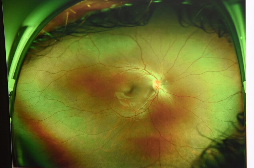 A picture of a patient’s retina is displayed at the optometry clinic March 11, 2016, at Malmstrom Air Force Base, Mont. The clinic is the only one in Montana that has a retinal imagining device called an Optos, used to look at the retina without diluting it. (U.S. Air Force photo/Senior Airman Jaeda Tookes) 
