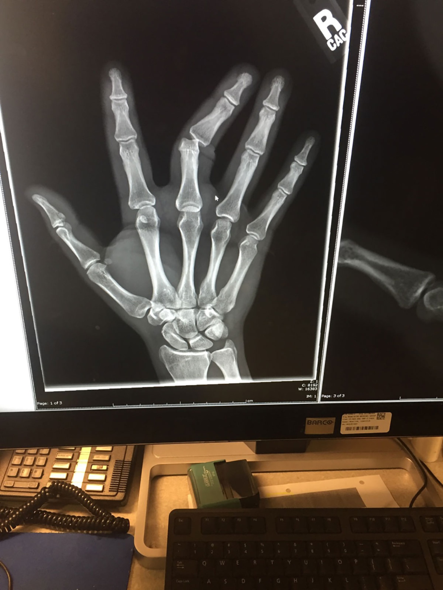 An X-ray shows the injury Air Force Master Sgt. Robert Wagner, 773d Civil Engineer Squadron primary security manager, suffered in October at the Joint Base Elmendorf-Richardson hospital Feb. 26, 2016. He injured his finger while blocking a ball as the goalie on the CE team during a game of intramural soccer. (Courtesy Photo)