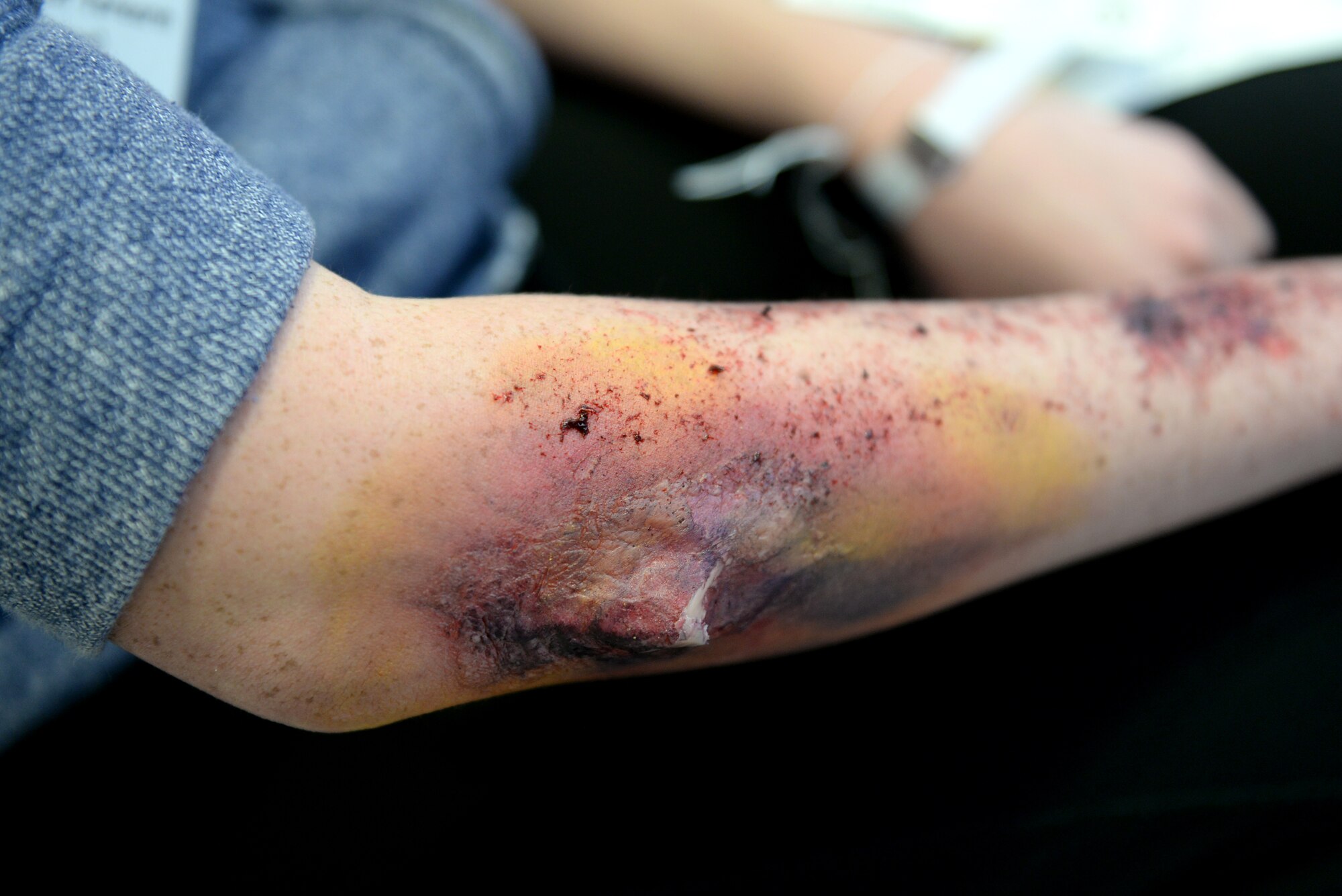 A patient with a broken bone awaits treatment during the mass casualty exercise held at Langley Air Force Base, Va., March 24, 2016. To ensure accuracy, realistic injuries, such as broken bones, blood and serious trauma were created to help medical staff become comfortable when dealing with such injuries sustained during possible mass casualty events. (U.S. Air Force photo by Airman 1st Class Kaylee Dubois)