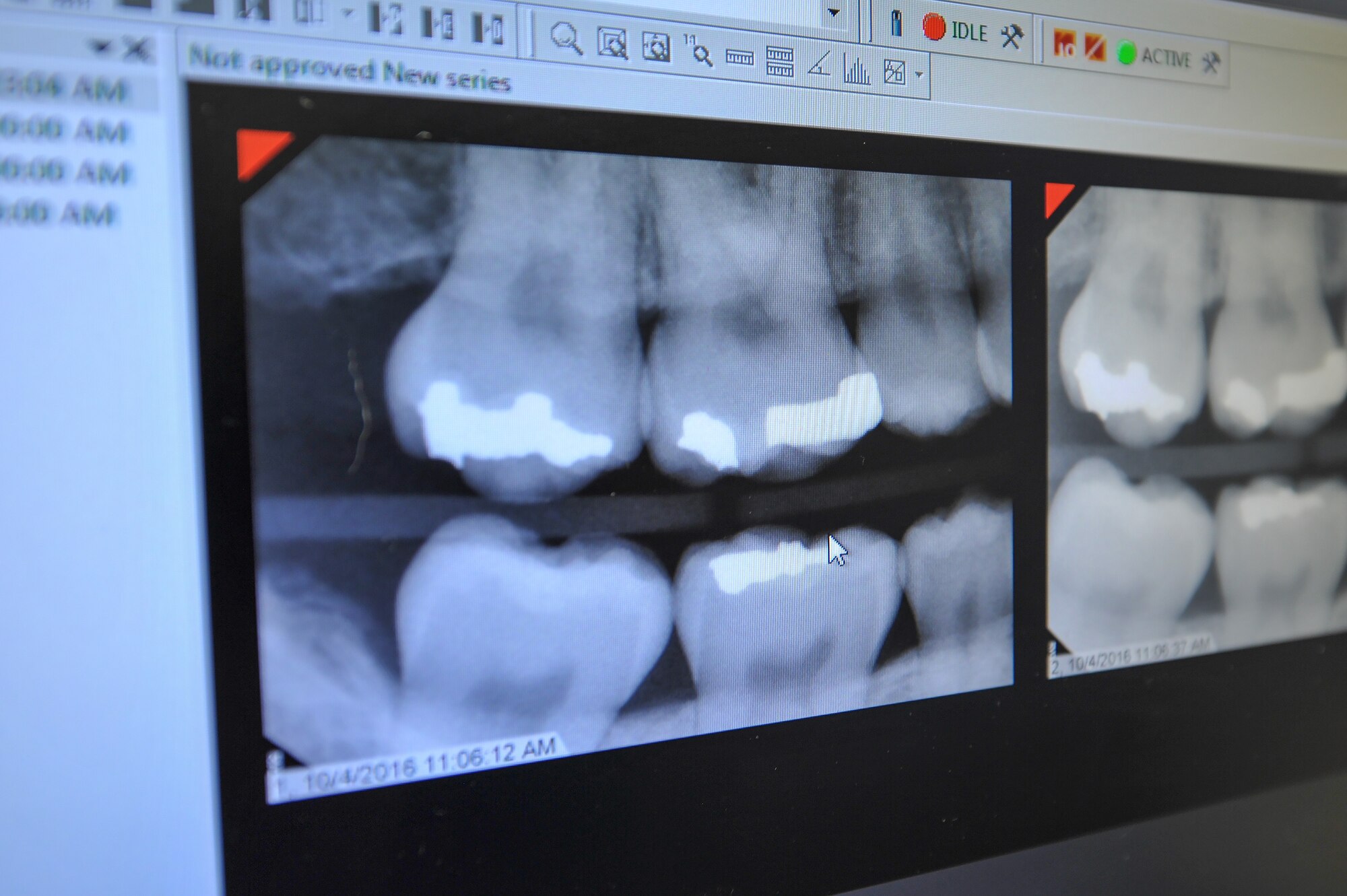 X-rays are displayed on a computer screen for a dentist to review at Hurlburt Field, Fla., Oct. 4, 2016. X-rays are used by dentists during annual exams to identify any imperfections in the patient’s teeth that may need treatment. (U.S. Air Force photo by Senior Airman Jeff Parkinson/Released)
