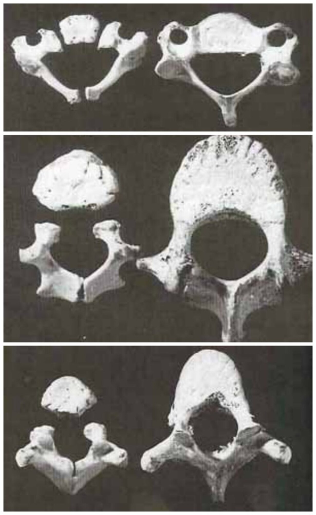 Image shows non-fused areas of the bone in the tailbone and pelvic areas in children. (courtesy photo/ carseatsforthelittles.org)