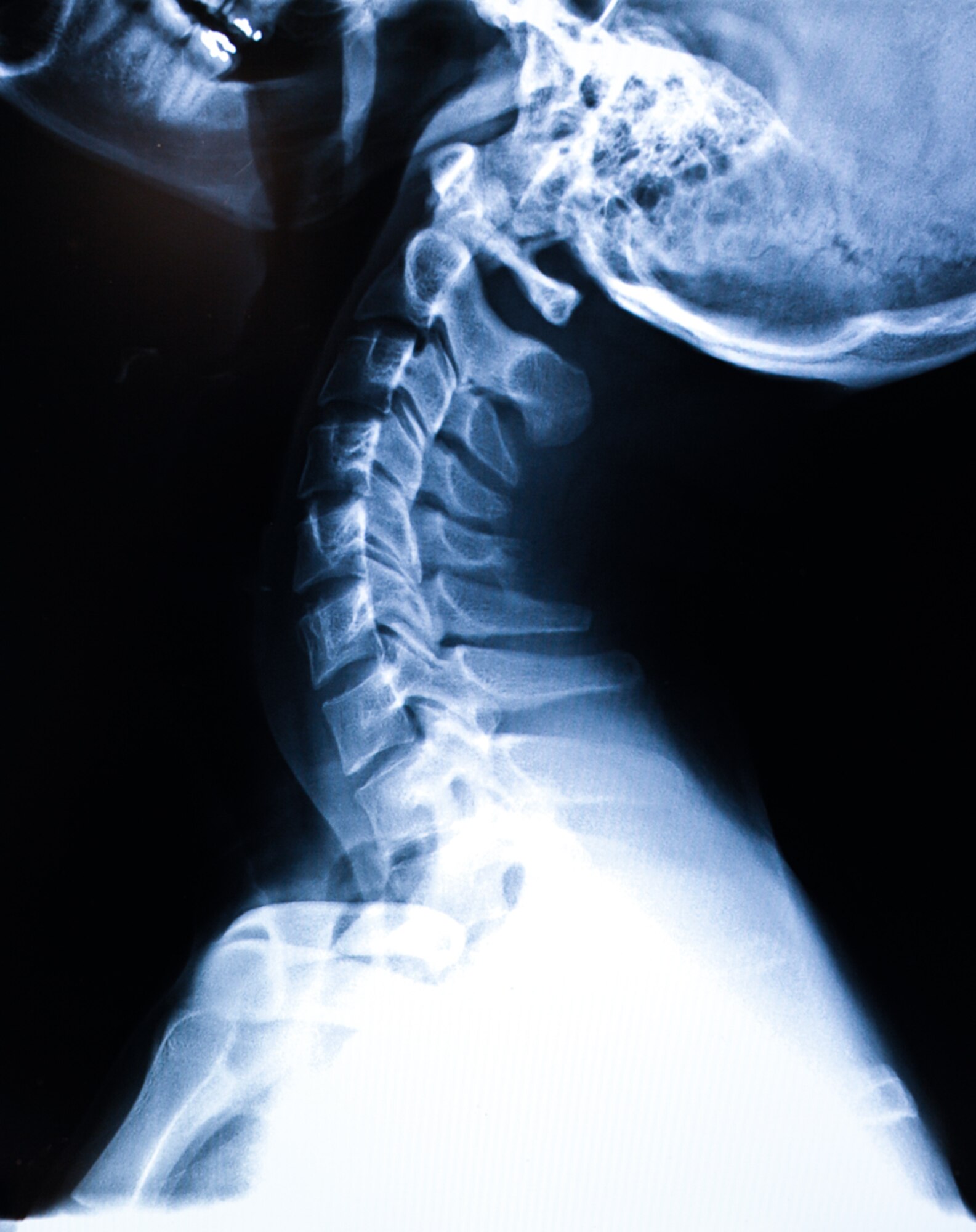 An x-ray is displayed at the 86th Medical Support Squadron’s radiology clinic, Ramstein Air Base Germany, Sept. 29, 2016. More than 2,000 x-rays are taken per year at the 86th MDSS. (U.S. Air Force photo/ Airman 1st Class Savannah L. Waters)