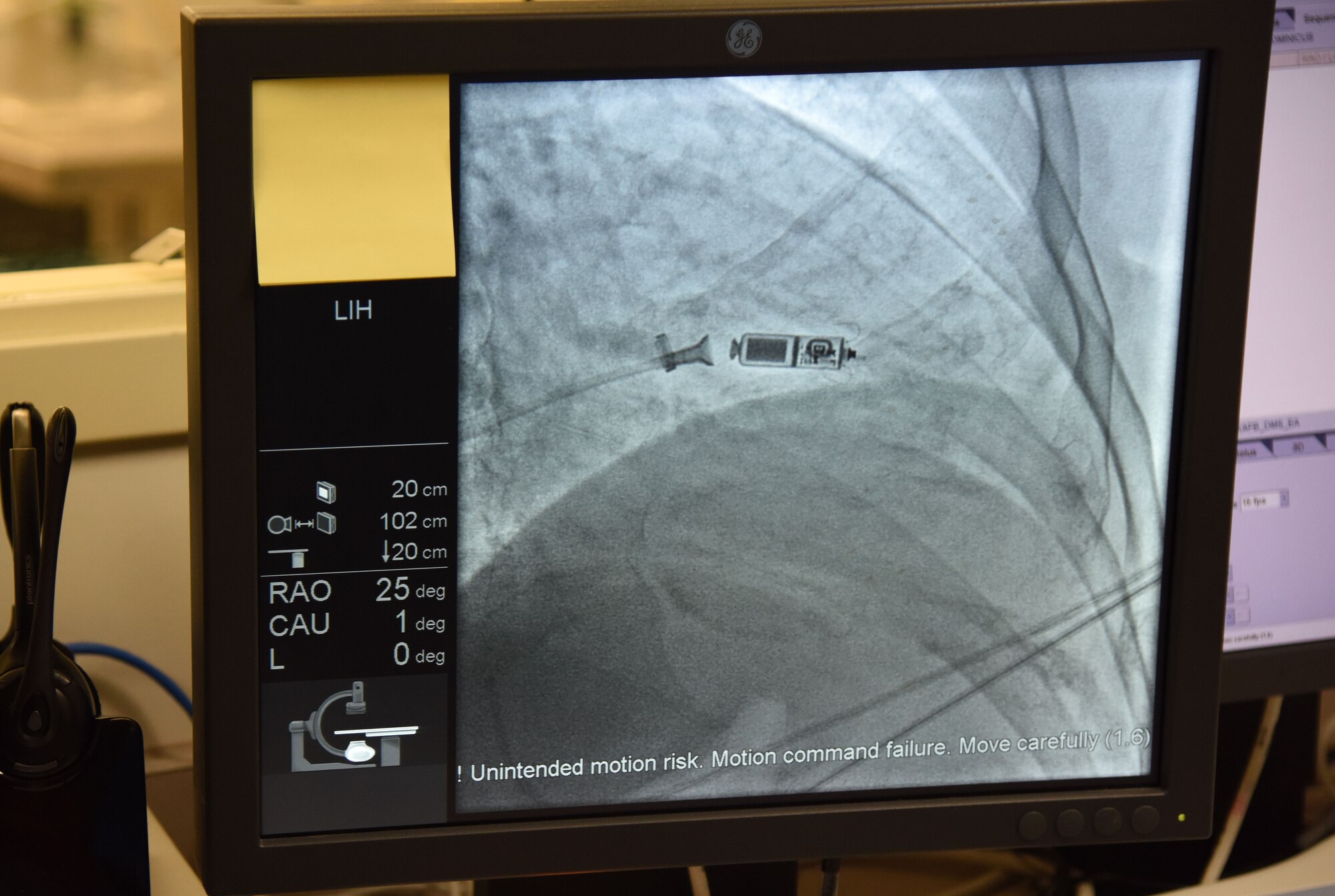 Medical professionals insert a Micra Transcatheter Pacing System into a patient at the Keesler Medical Center April 13, 2017, on Keesler Air Force Base, Miss. The Micra Transcatheter Pacing System is a new type of heart device that provides patients with the most advanced pacing technology at one-tenth the size of a traditional pacemaker. Keesler is the first Air Force hospital to offer the world’s smallest pacemaker for patients with bradycardia.. (U.S. Air Force photo by Kemberly Groue)