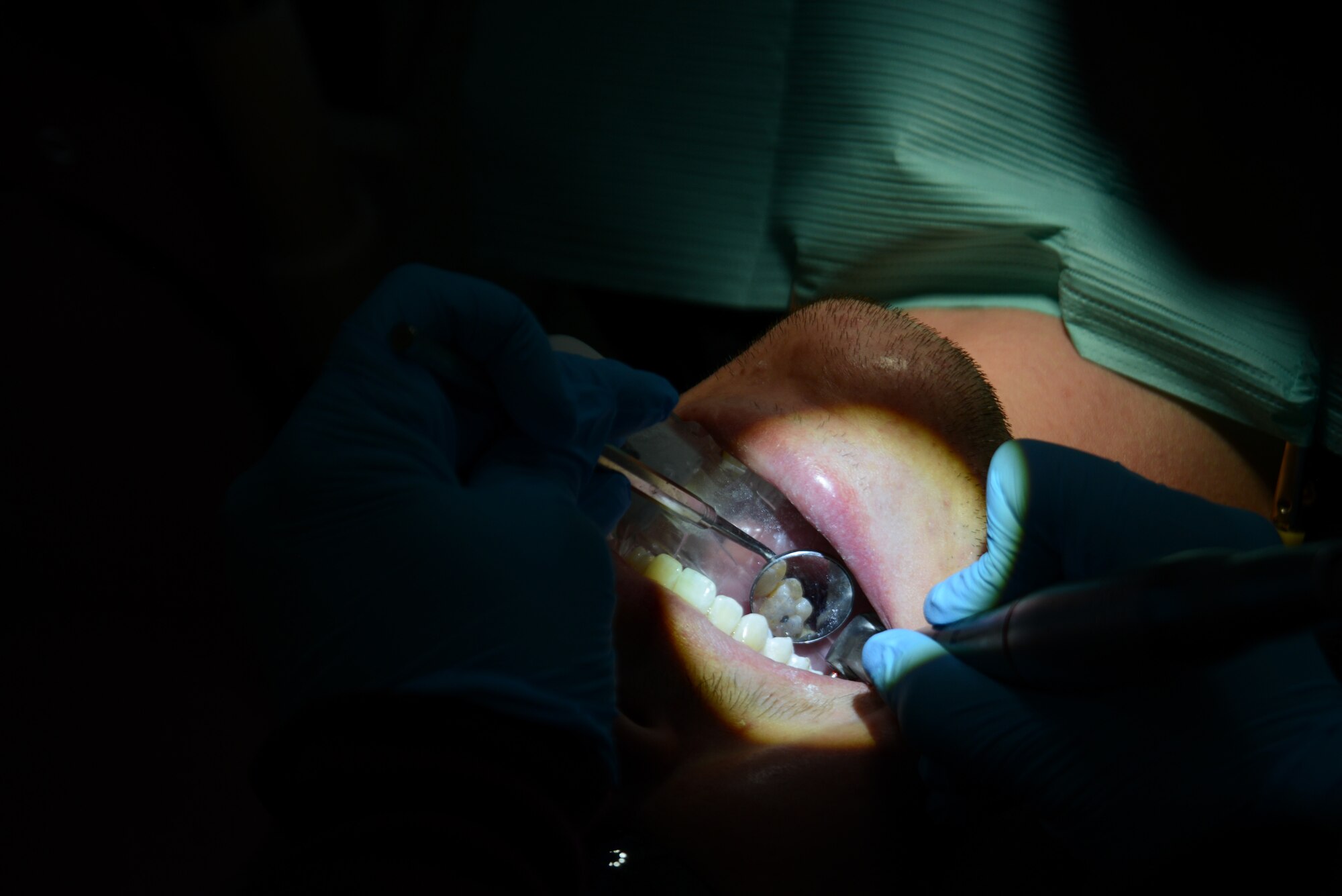 Air Force Maj. Nicole Smith, 673d Dental Squadron prosthodontist, prepare Airman 1st Class Ian McKinney’s, 673d Security Forces Squadron alarm monitor specialist, teeth for a temporary crown at the Joint Base Elmendorf-Richardson Hospital, Alaska, Aug. 14, 2017. A cavity or incomplete tooth needs a crown to prevent further damage. The dentist removes any decay and the outer layer of the tooth so the crown fits like a cap.
