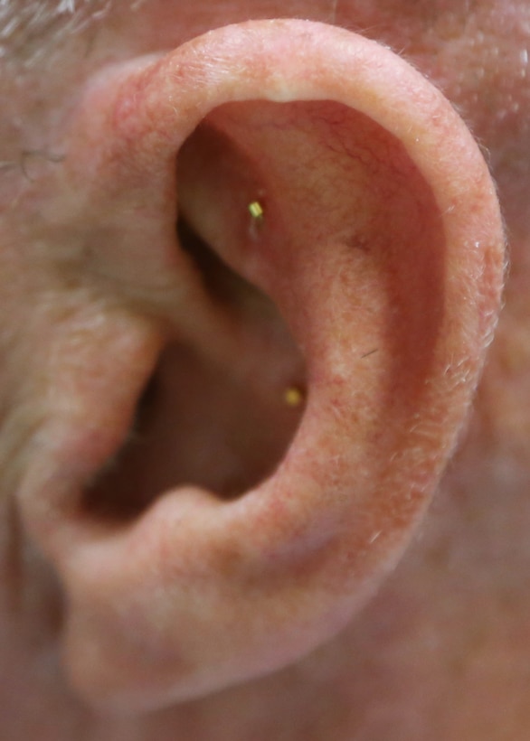 Battlefield acupuncture is a unique auricular (ear) acupuncture procedure.