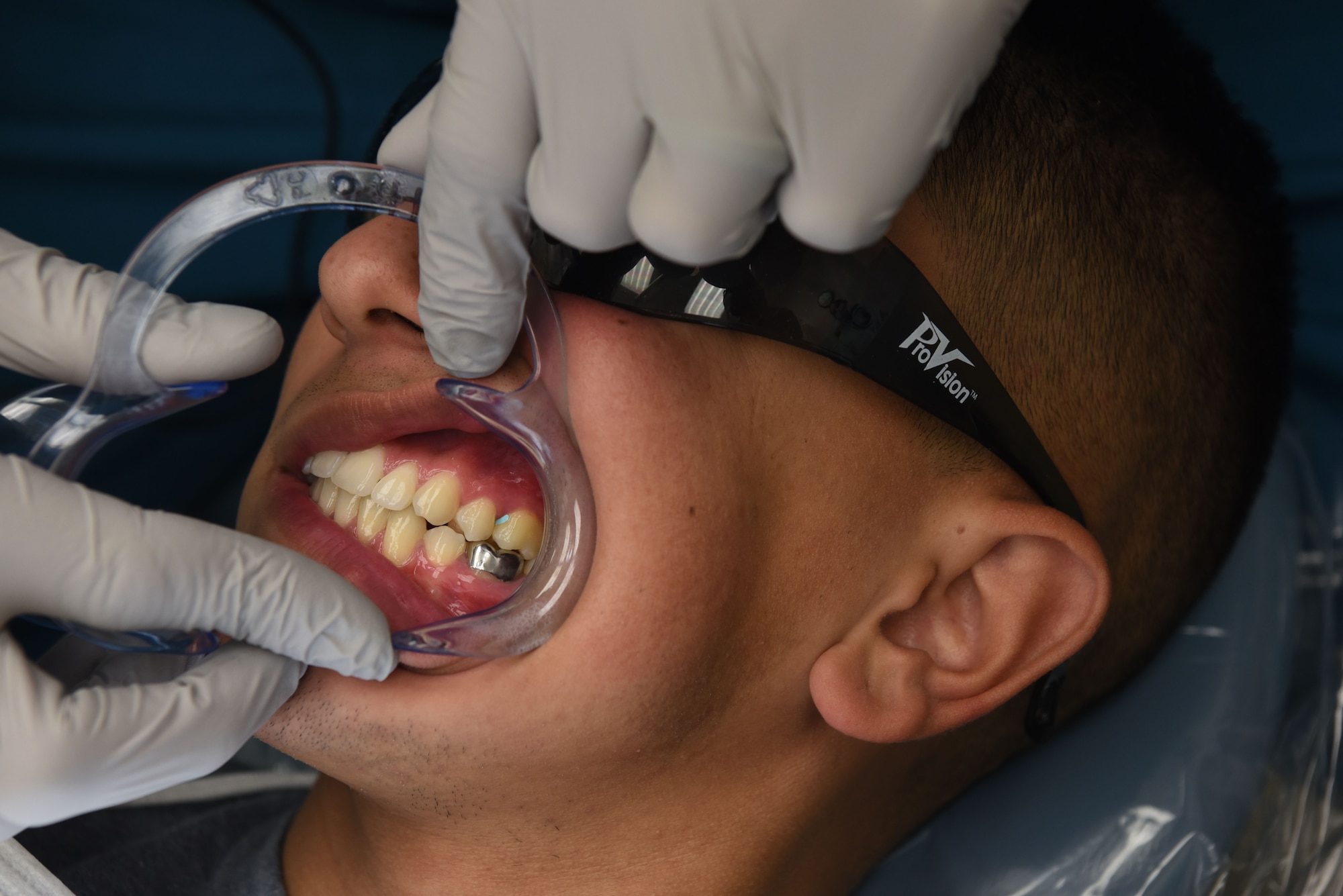 Captain Corey Cook, 90th Medical Group dentist, inspects the patients silver crown before starting the procedure of replacing the current crown with a reinforced porcelain crown at the dental clinic on F.E. Warren Air Force Base, Wyo., Dec. 19, 2017. The crown replacement provided a more natural looking tooth. The mission of the U.S. Air Force Dental Corps is to achieve superior oral health and global readiness through safe, effective and patient-centered care. (U.S. Air Force photo by Airman 1st Class Abbigayle Wagner)