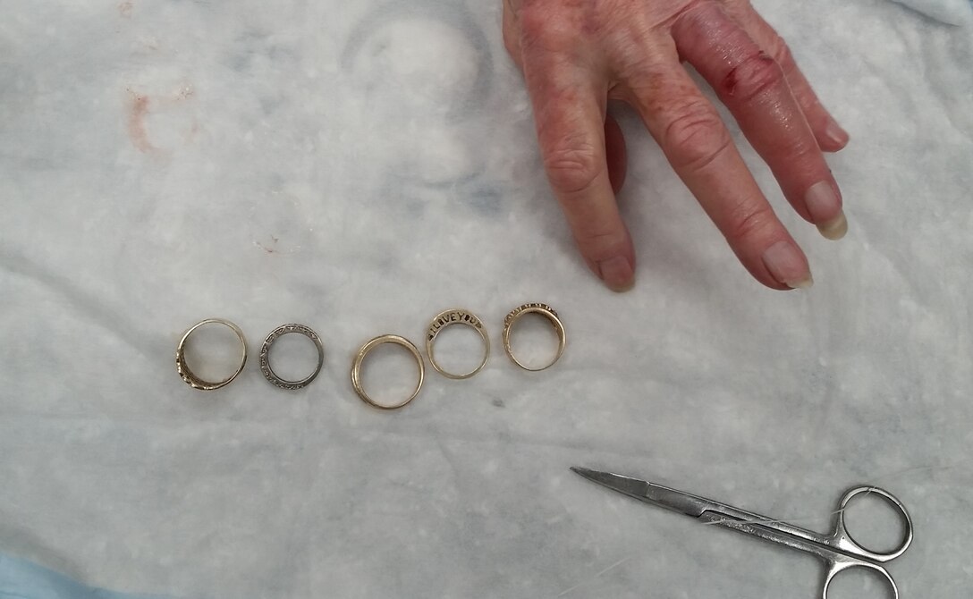 This patient, who had recently buried her husband who was a WWII POW vet, said she started wearing one of his rings in memory of him, in addition to the four rings she already wore. Unfortunately, this fifth ring contained nickel, causing an allergic reaction and severe swelling in her. This prevented her from taking off any of the rings and risked cutting off all circulation to her finger. 