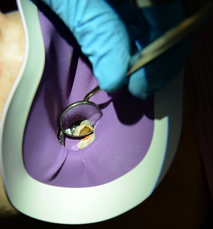 U.S. Army Maj. Bryan Horspool, U.S. Army Dental Command endodontist, examines a patient’s mouth at the Tignor Dental Clinic at Joint Base Langley-Eustis, Va., March 10, 2017. The clinic sees active duty members and Advanced Individual Training students for appointments such as cleanings, annual exams, root canals, fillings and extractions. (U.S. Air Force photo/Staff Sgt. Teresa J. Cleveland)