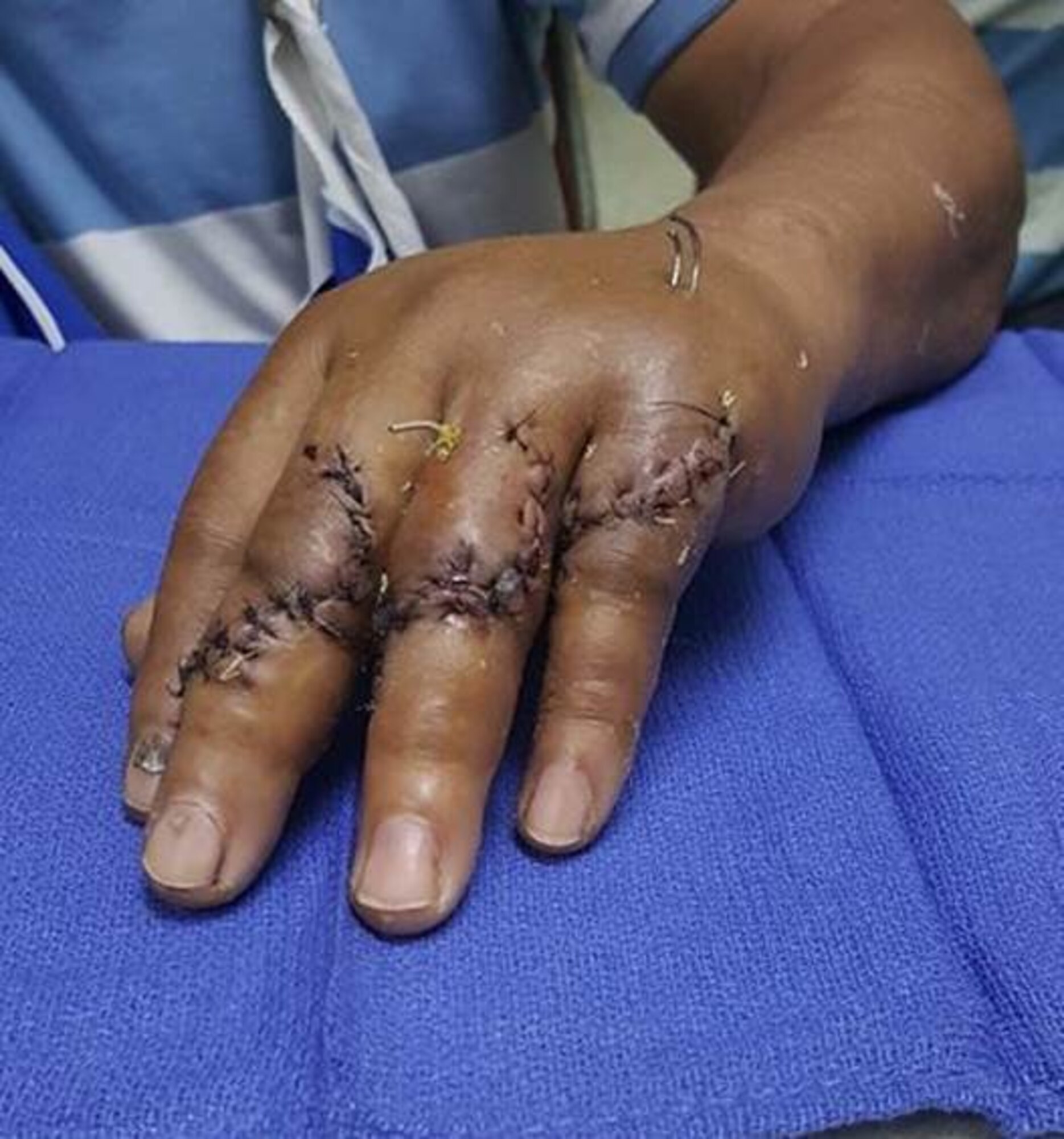 A Honduran patient displays the ‘handy’ work of Brooke Army Medical Center and local surgeons. The Brooke Army Medical Center team conducted a medical readiness exercise in Tegucigalpa, Honduras Sept. 16-30, focusing on orthopedic procedures to hand and arm injuries. (U.S. Army photo/Released)