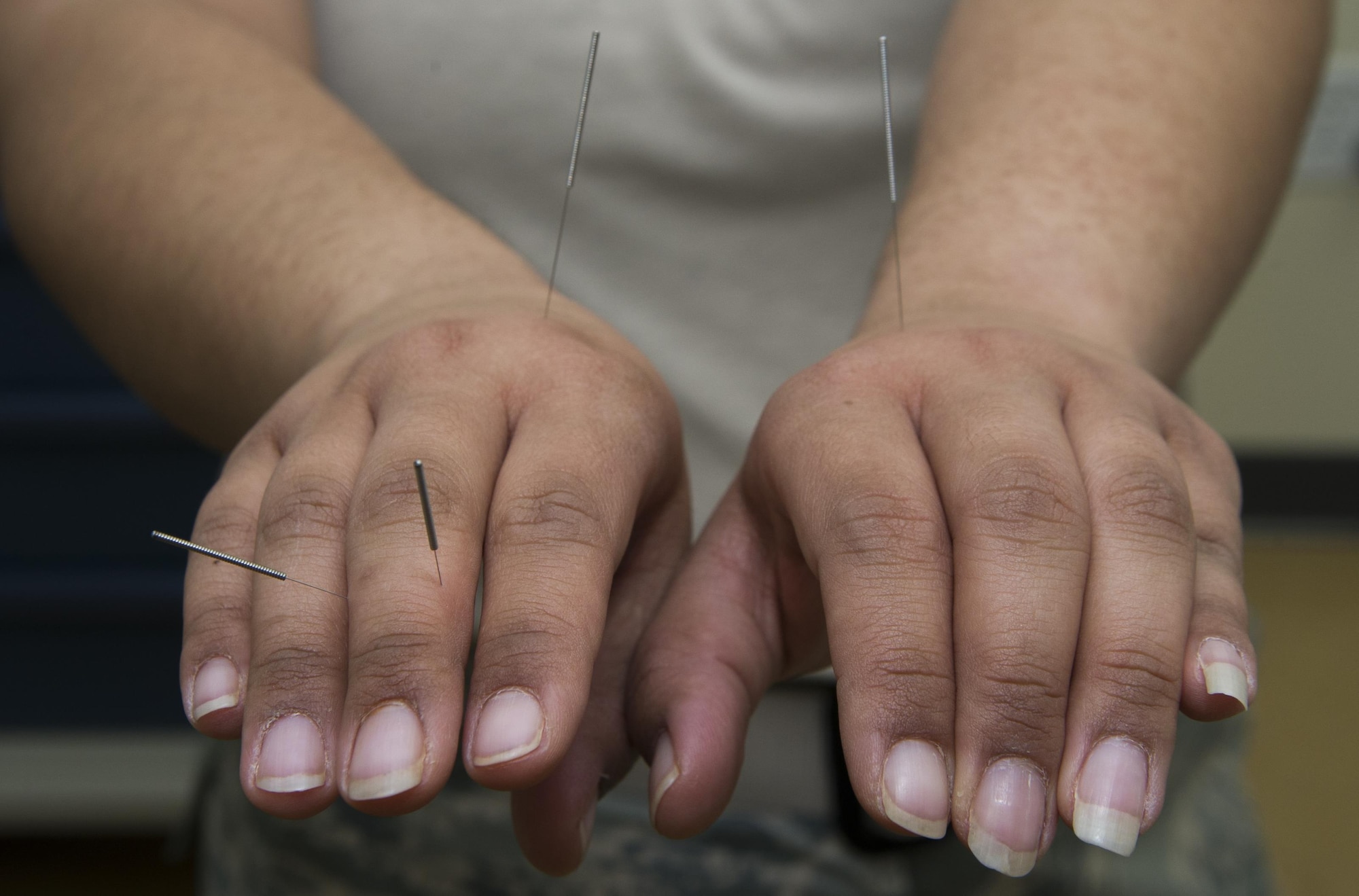 The 673d Surgical Operations Squadron Pain Clinic now has a licensed acupuncturist and medical massage therapist added to their multidisciplinary pain management team at Joint Base Elmendorf-Richardson, Alaska, April 27, 2017. The Pain Clinic is the first to have a licensed acupuncturist and medical massage therapist in the Air Force. 