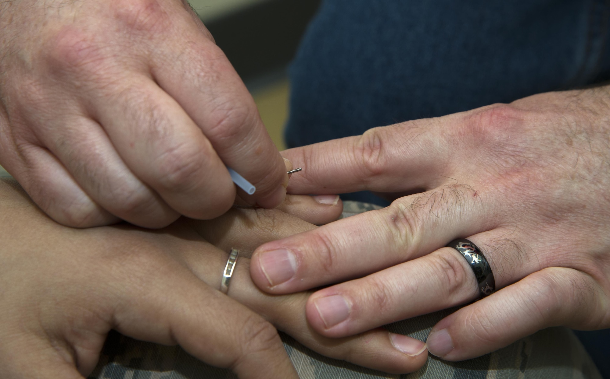 Licensed Acupuncturist Tim Iliff, 673d Surgical Operations Squadron pain clinic, inserts an acupuncture needle into a patient at Joint Base Elmendorf-Richardson, Alaska, April 27, 2017. 