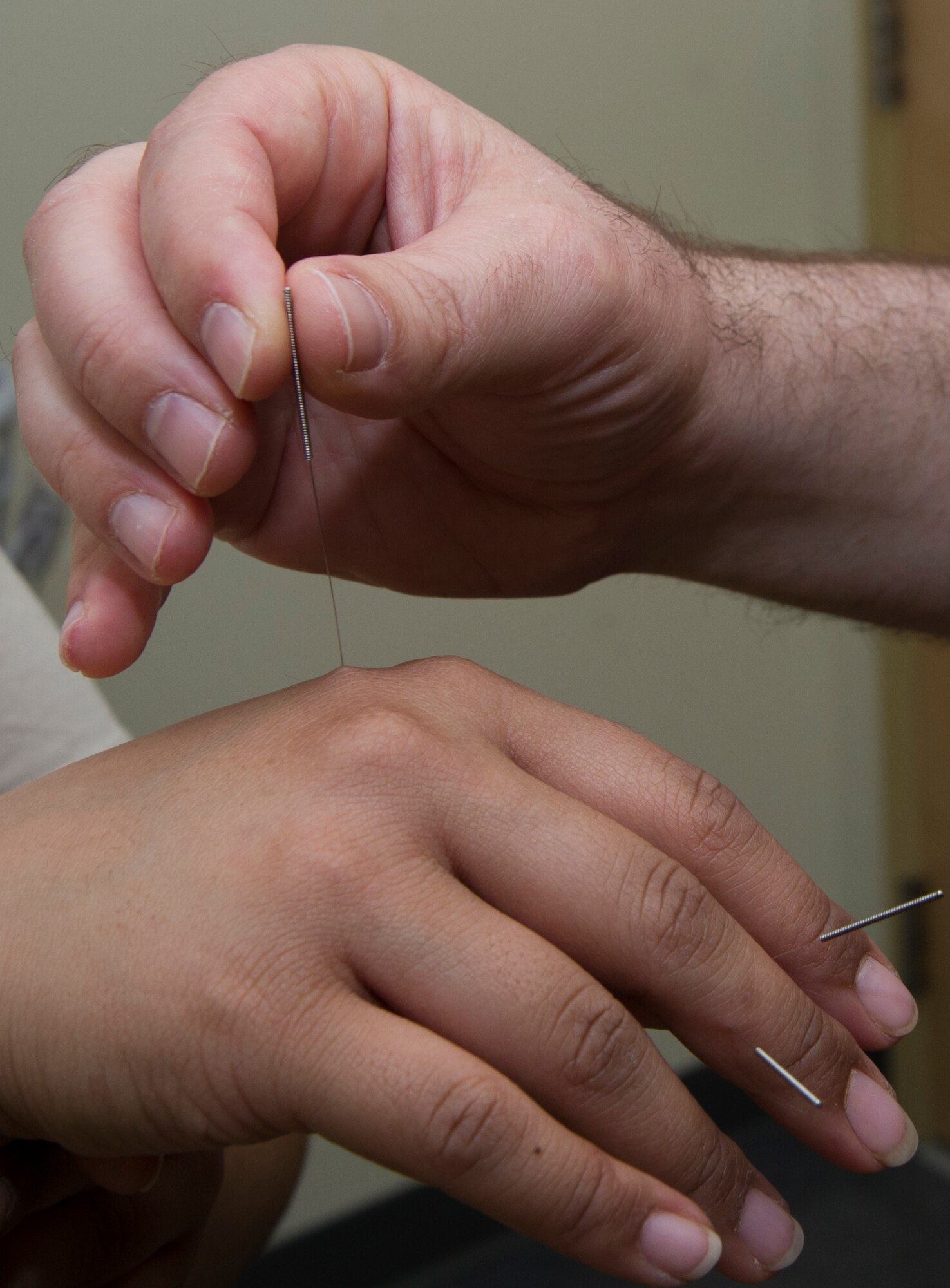 Licensed Acupuncturist Tim Iliff, 673d Surgical Operations Squadron pain clinic, removes an acupuncture needle from a patient at Joint Base Elmendorf-Richardson, Alaska, April 27, 2017. Acupuncture is a form of alternative medicine to help patients get off pain medications. 