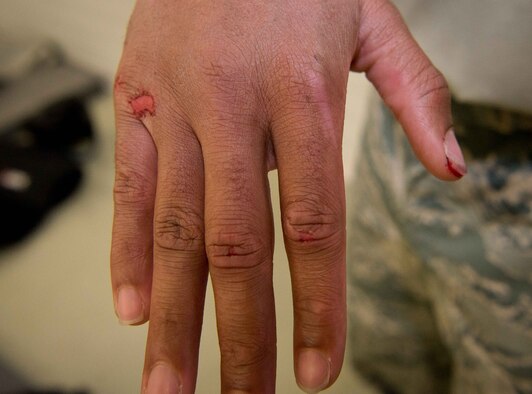 Airman 1st Class Cameron Rogers, 86th Security Forces Squadron control center technician, shows the scrapes on his hand after baton training on Ramstein Air Base, Germany, April 27, 2017. Rogers participated in baton training against multiple aggressors to tests his endurance and prepare him for Phoenix Ravens qualification training, where he will learn help detect, deter and counter threats to Air Mobility Command aircraft. (U.S. Air Force photo by Senior Airman Elizabeth Baker/Released) 