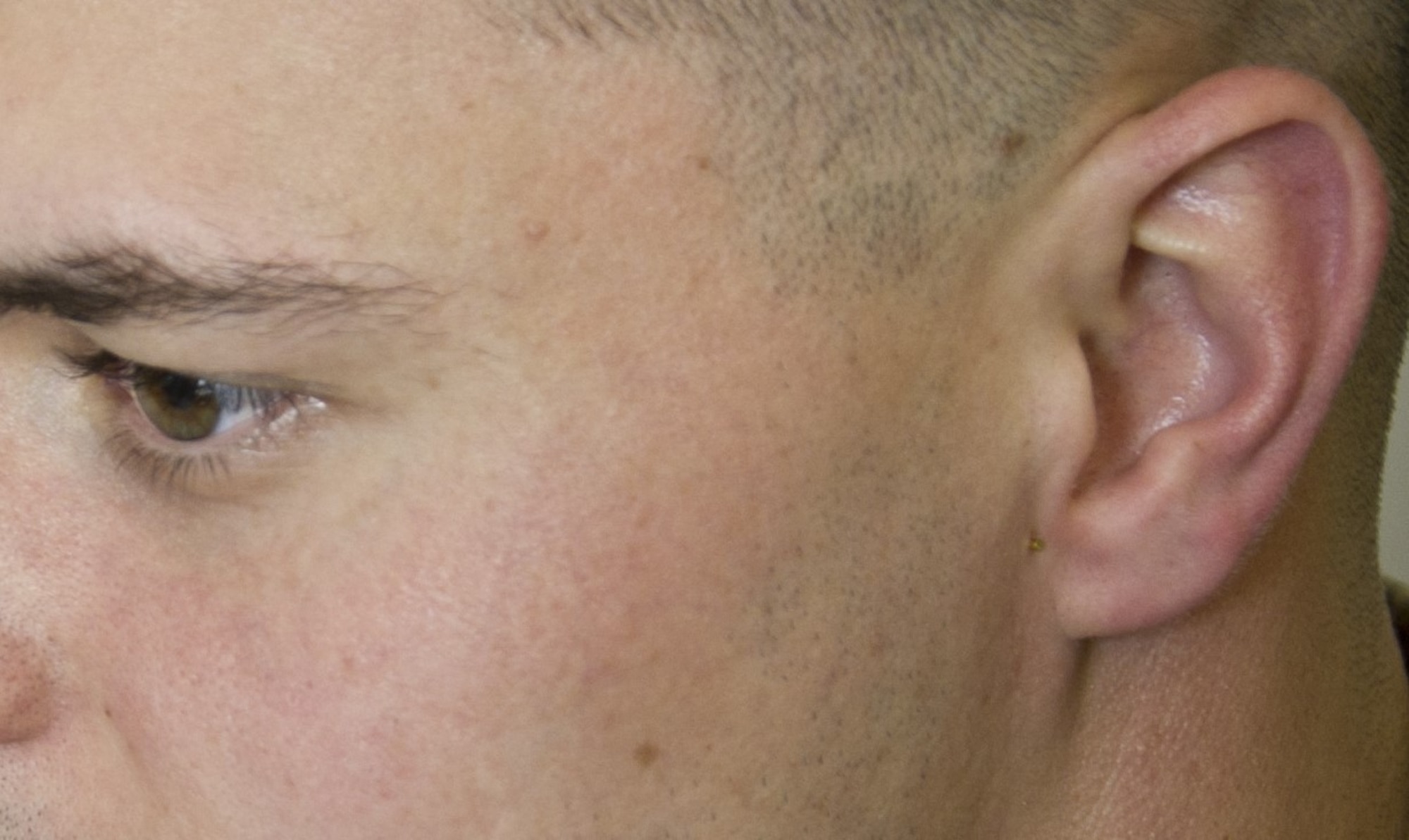A semi-permanent acupuncture needle, or ASP, is inserted next to the ear of 2nd Lt. Paul Schroeder, a Uniformed Services University student working with the 779th Medical Group’s Air Force Acupuncture and Integrative Medicine Clinic staff March 28, 2017 at Joint Base Andrews, Md. Auricular therapy is one kind of acupuncture protocol that can be used on the battlefield because the placement of the ASPs can be learned by medical professionals who don’t specialize in acupuncture and the needles can remain in the ears from 3-5 days. Doing so, provides relief for patients suffering from some ailments such as anxiety, back pain, muscle stiffness and headaches. (U.S. Air Force photo by Staff Sgt. Joe Yanik)