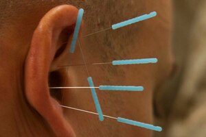 Acupuncture needles protrude from someone's ear.