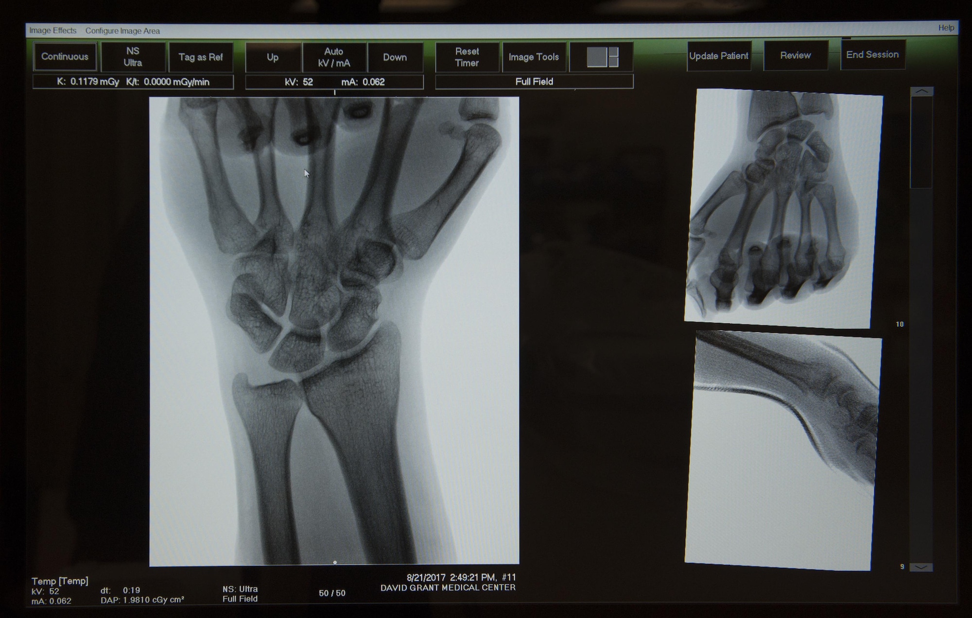 Image of the skeletal structure of a patient’s hand displayed on the monitor of a mobile X-ray machine, Aug. 22, 2017, at the Orthopedic Hand Clinic, David Grant U.S. Air Force Medical Center, Travis Air force Base. Calif.  DGMC's Orthopedic and Podiatry Clinics are comprised of dedicated and compassionate professionals who specialize in the comprehensive care of patients with bone and joint disorders of the extremities. (U.S. Air Force photo/ Heide Couch)