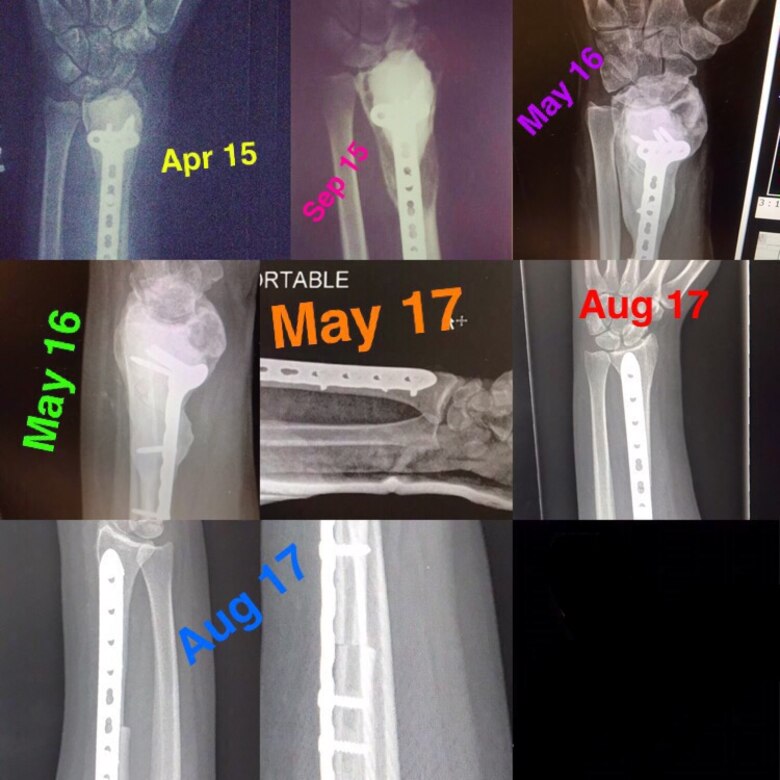 Over the course of three years, Gordon went through a year of chemotherapy and three surgeries and is now in remission with no visible sign of the tumor returning.