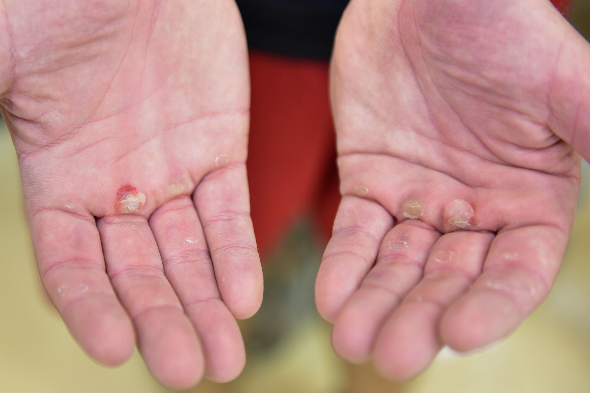 Airman Displays Callouses