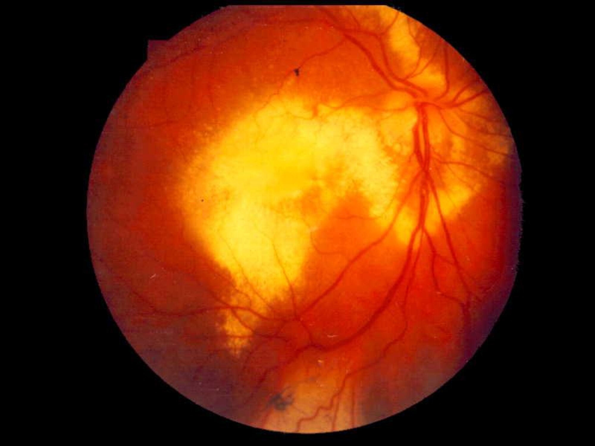 This image shows deposits of cholesterol on the back of an eye affected by Coats’ Disease. The rare, congenital disease, only found in about one in 100,000 people, is caused by abnormal blood vessel development behind the retina. The affected blood vessels leak blood content into the eye leading to partial or complete retinal detachment if not treated. (Courtesy photo)
