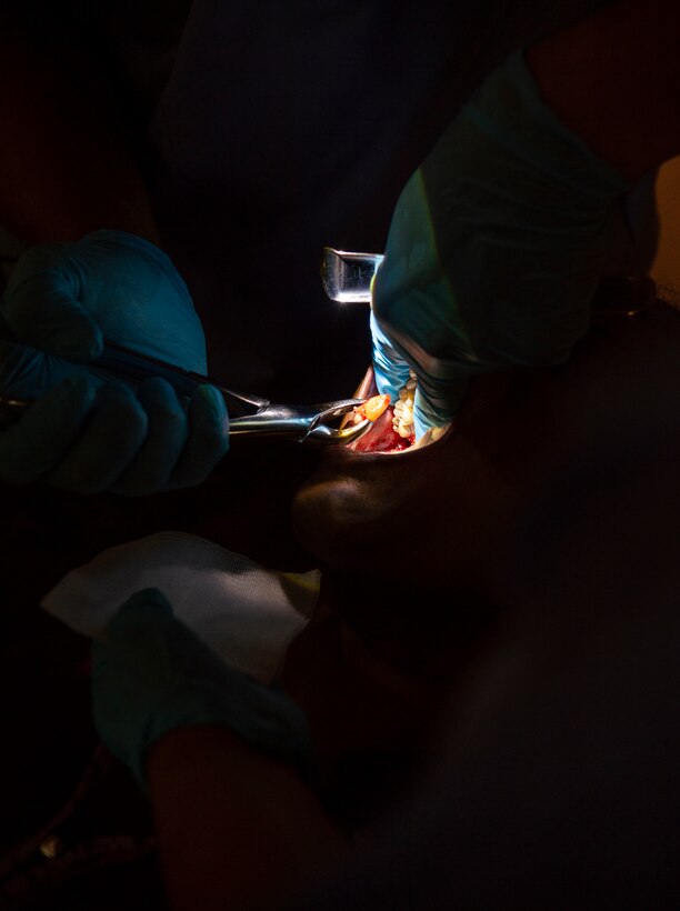 U.S. Marine Corps Lt. Cmdr. Rodney Martin, 1st Dental Battalion, Camp Pendleton, Calif., extracts a tooth during the first day of the Pacific Angel (PAC ANGEL) 18-4 health services outreach event in Vavuniya, Sri Lanka, Aug. 13, 2018.
