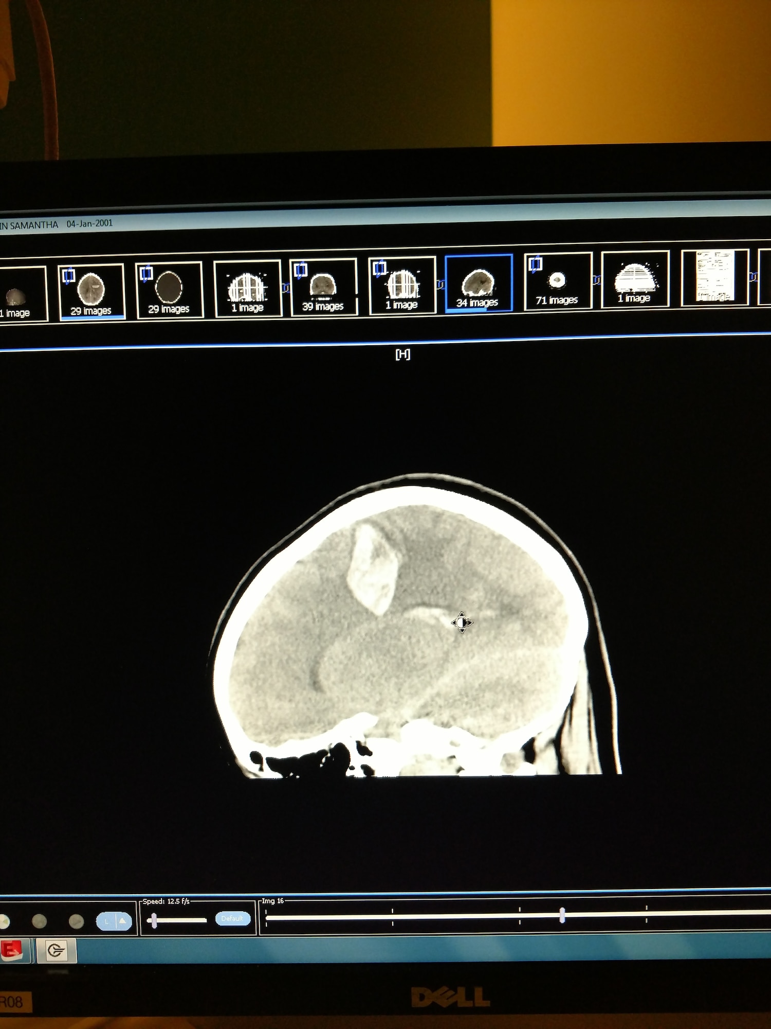 The whitish area at the top of this CT scan shows where blood pooled after an arterial venous malformation ruptured inside Samantha Pipkin’s brain Feb. 2, 2017, causing a hemorrhagic stroke.  (Courtesy photo).