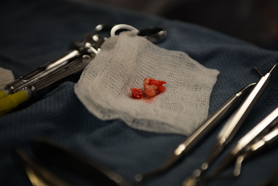 Wisdom teeth removed by 20th Dental Squadron (DS) personnel lay on a cloth at the 20th DS on Shaw Air Force Base, S.C., Jan. 17, 2018.