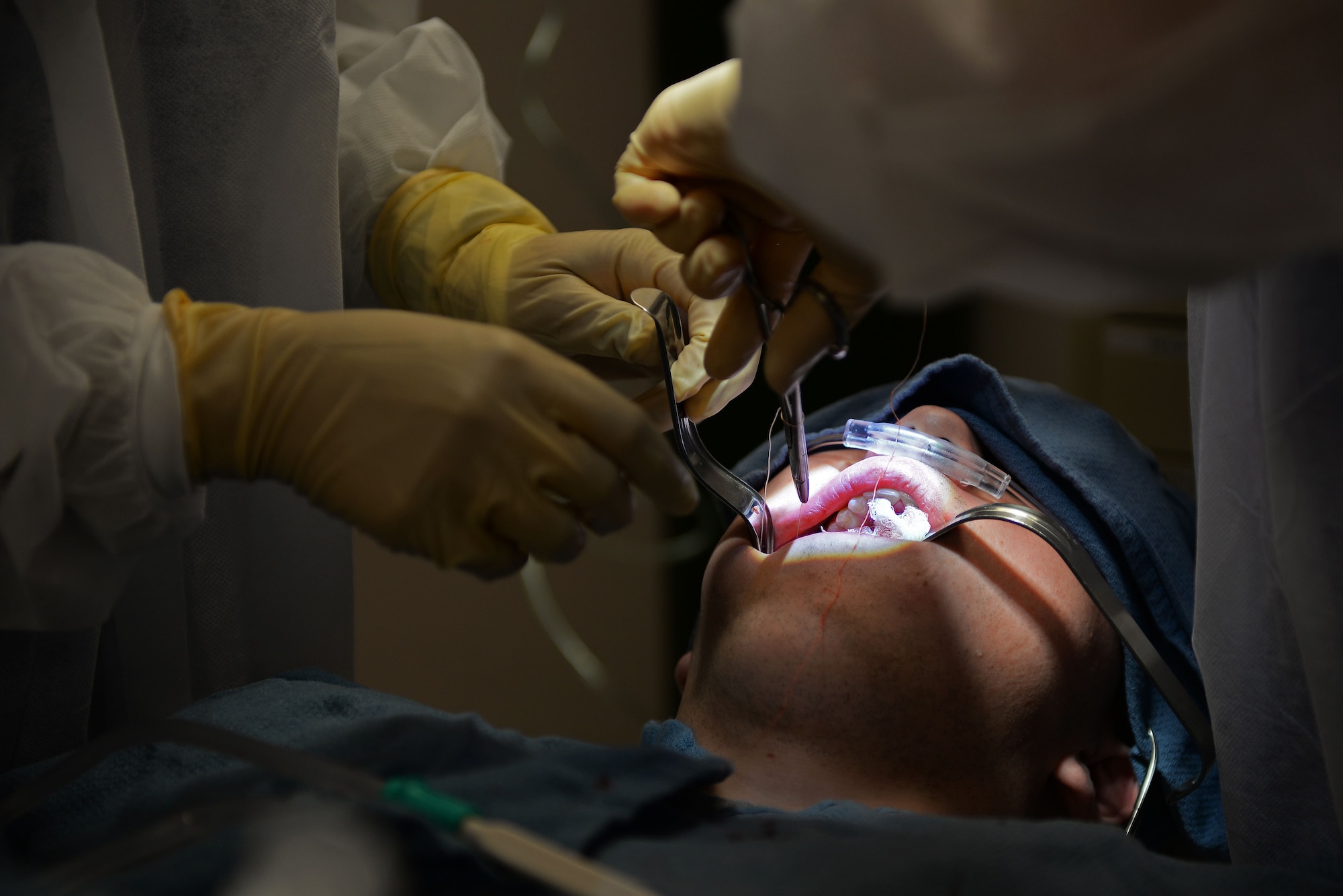 U.S. Air Force Maj. Jamie Smith, 20th Dental Squadron dental flight commander, and Airman 1st Class Apryl-Len Cabase, 20th DS dental technician, hold open a patient’s mouth to remove his wisdom teeth at Shaw Air Force Base, S.C., Jan. 17, 2018.