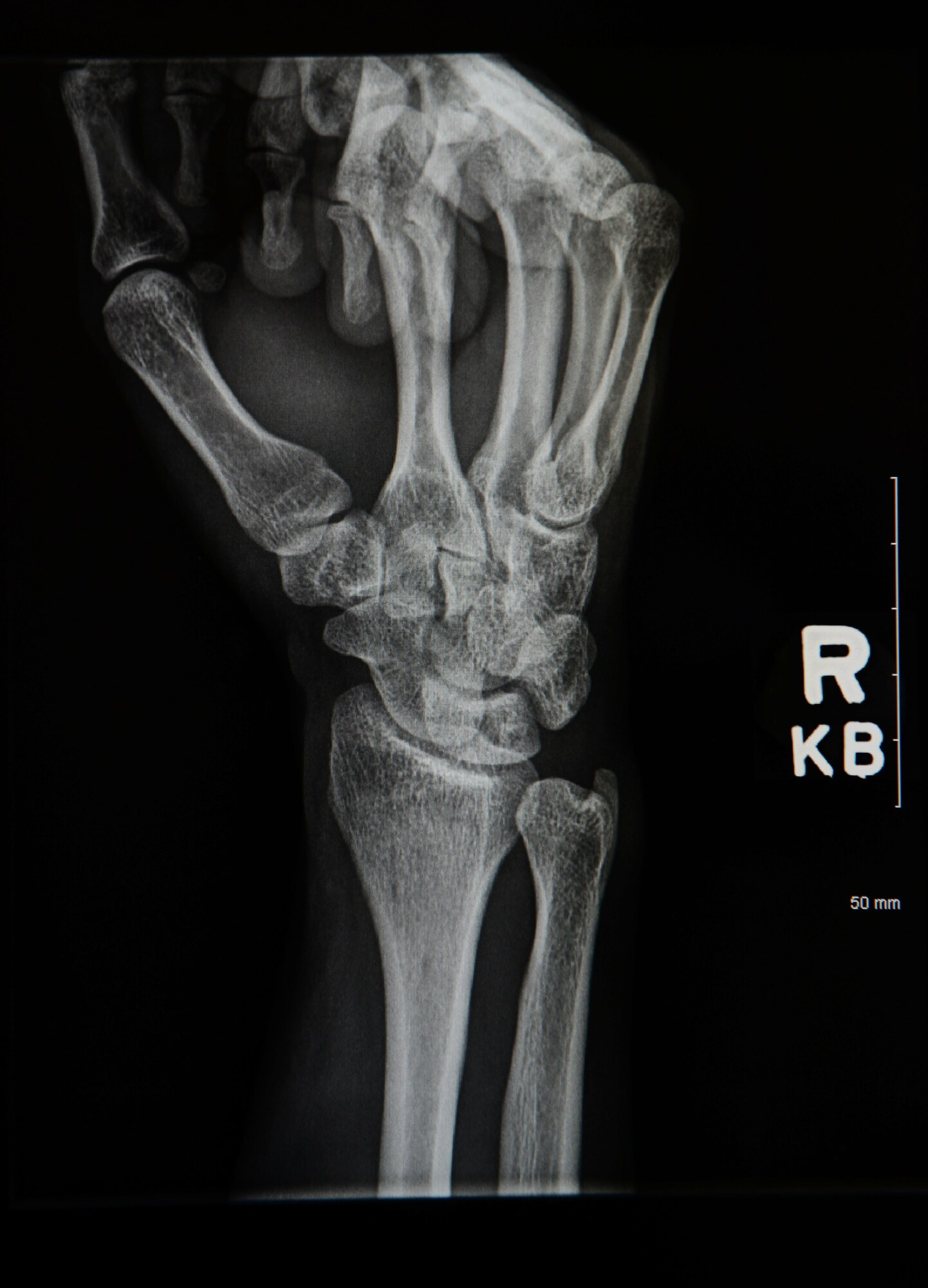 An x-ray of a right hand is displayed to identify any fractures or breaks at Shaw Air Force Base, S.C., March 7, 2018.