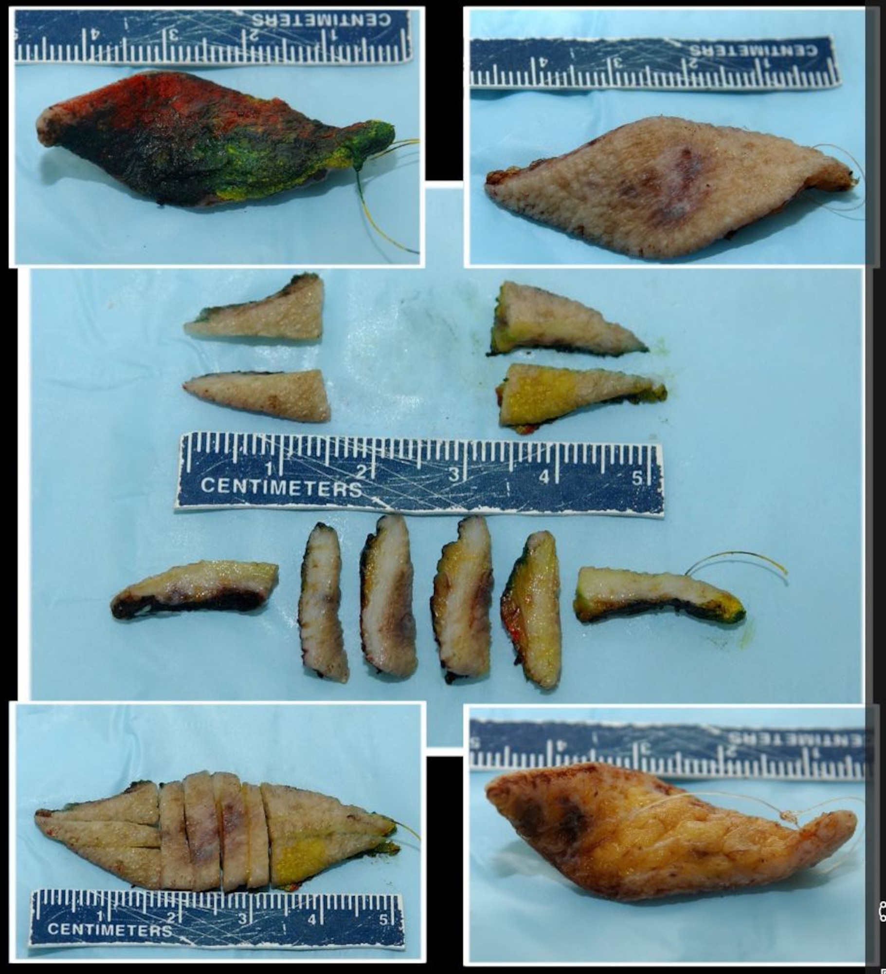 Photo illustration of skin tissue resection to show malignant melanoma of the skin. “The operation is intended to cure a skin cancer patient by taking the cancer out with a “safety margin” of 1-2 cm around it,” said Dr. Al Elsayed, David Grant USAF Medical Center staff pathologist. “The undersurface of the specimen is colored by a special non-running ink so we can measure under the microscope how far is the cancer from to the margin of the specimen that the surgeon removed…If the cancer is "too close" the clinician may go back and remove more tissue from that particular location to provide an additional safety margin to make sure the cancer does not return.” (U.S. Air Force photo illustration by Tech. Sgt. Liliana Moreno/Released)