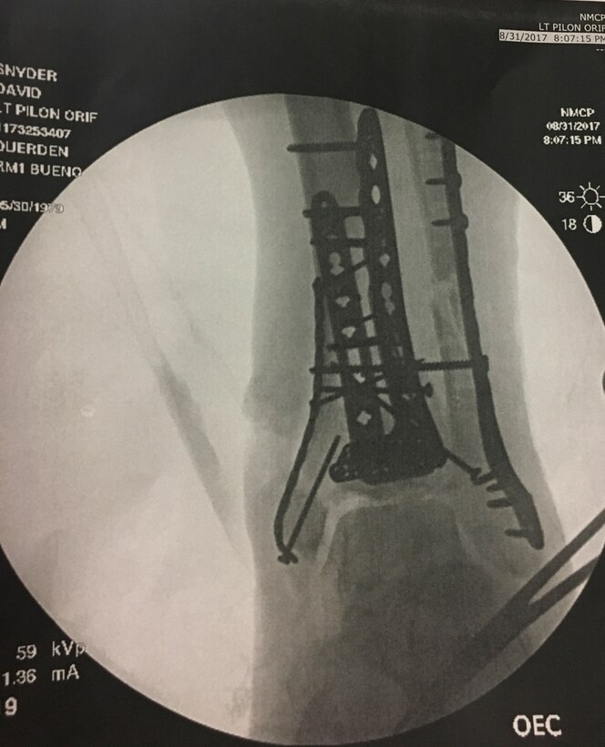 X-ray of leg