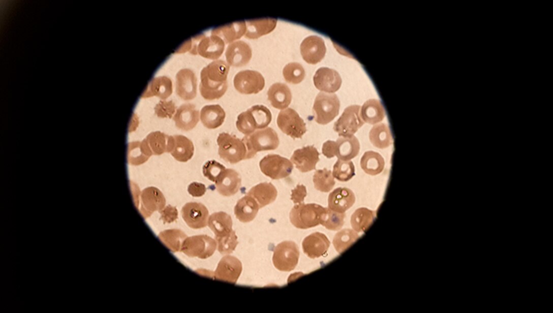 A sample rests under a microscope March 28, 2019, at Incirlik Air Base, Turkey. Besides blood samples, the 39th Medical Support Squadron tests many specimens to help diagnose patients. (U.S. Air Force photo by Staff Sgt. Matthew J. Wisher)